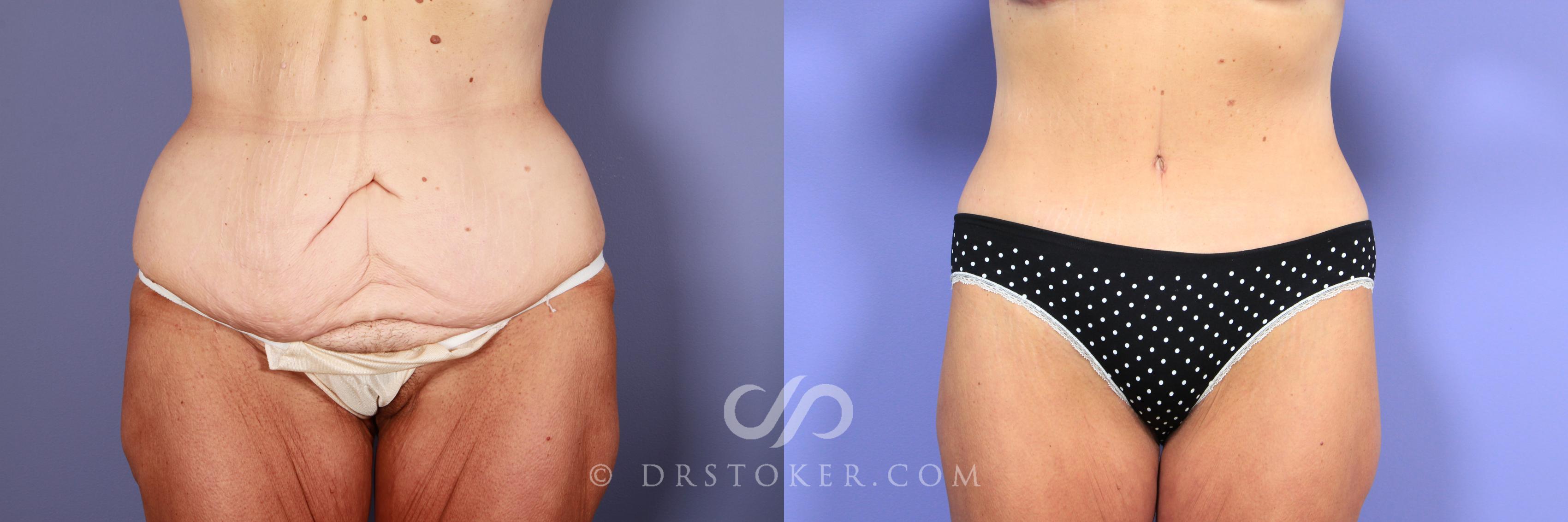 Before & After Tummy Tuck Case 771 View #1 View in Los Angeles, CA