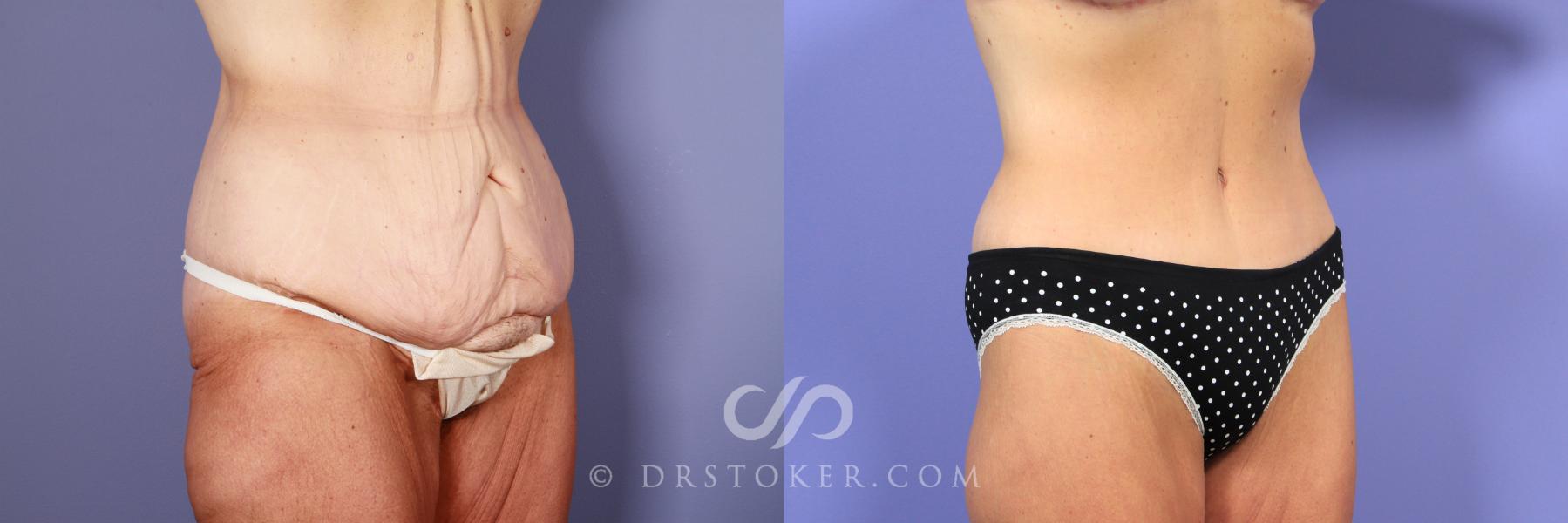 Before & After Tummy Tuck Case 771 View #2 View in Los Angeles, CA