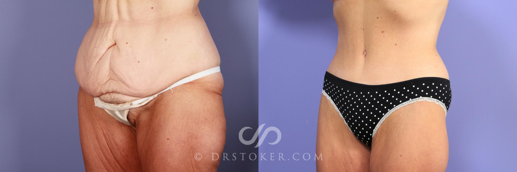 Before & After Tummy Tuck Case 771 View #3 View in Los Angeles, CA