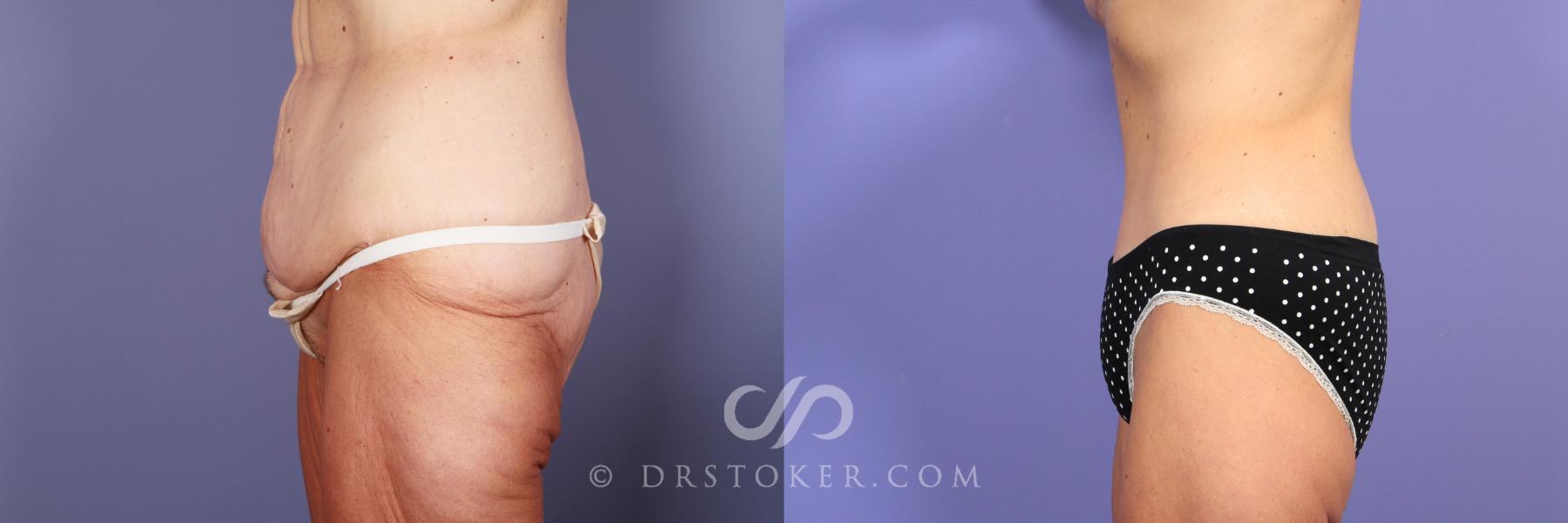 Before & After Tummy Tuck Case 771 View #5 View in Los Angeles, CA