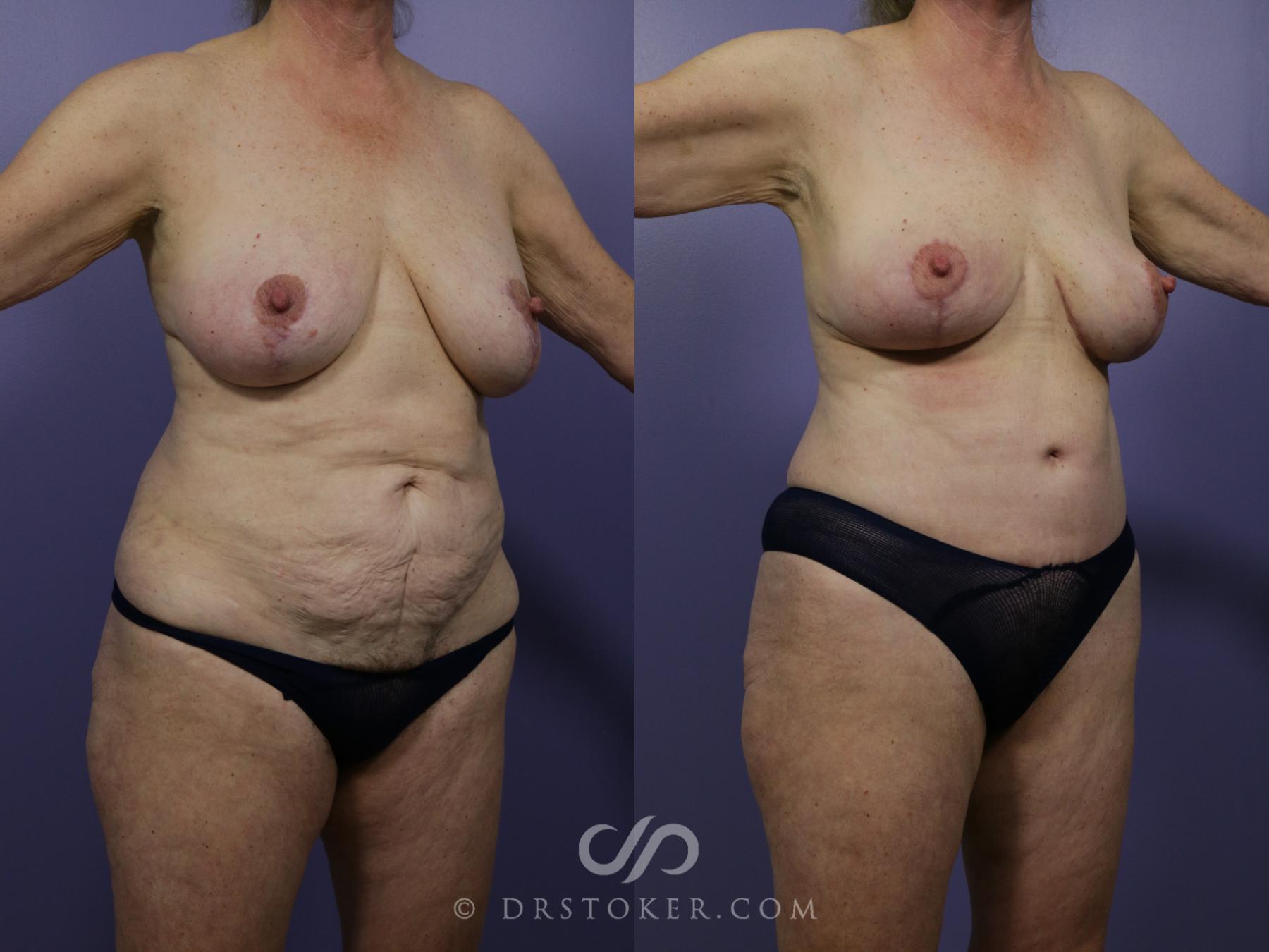 Before & After Tummy Tuck Case 772 View #2 View in Los Angeles, CA
