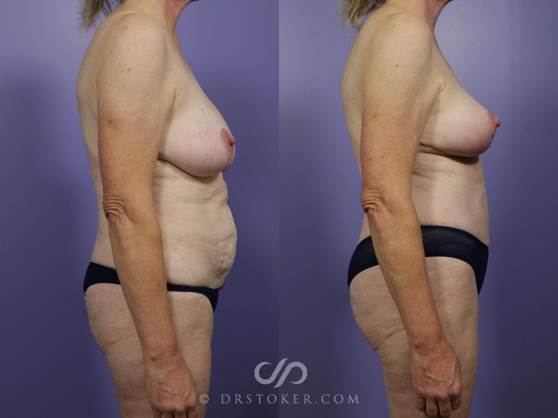 Before & After Tummy Tuck Case 772 View #3 View in Los Angeles, CA