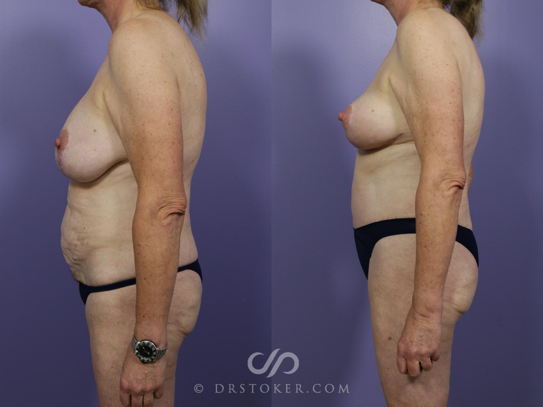 Before & After Tummy Tuck Case 772 View #4 View in Los Angeles, CA