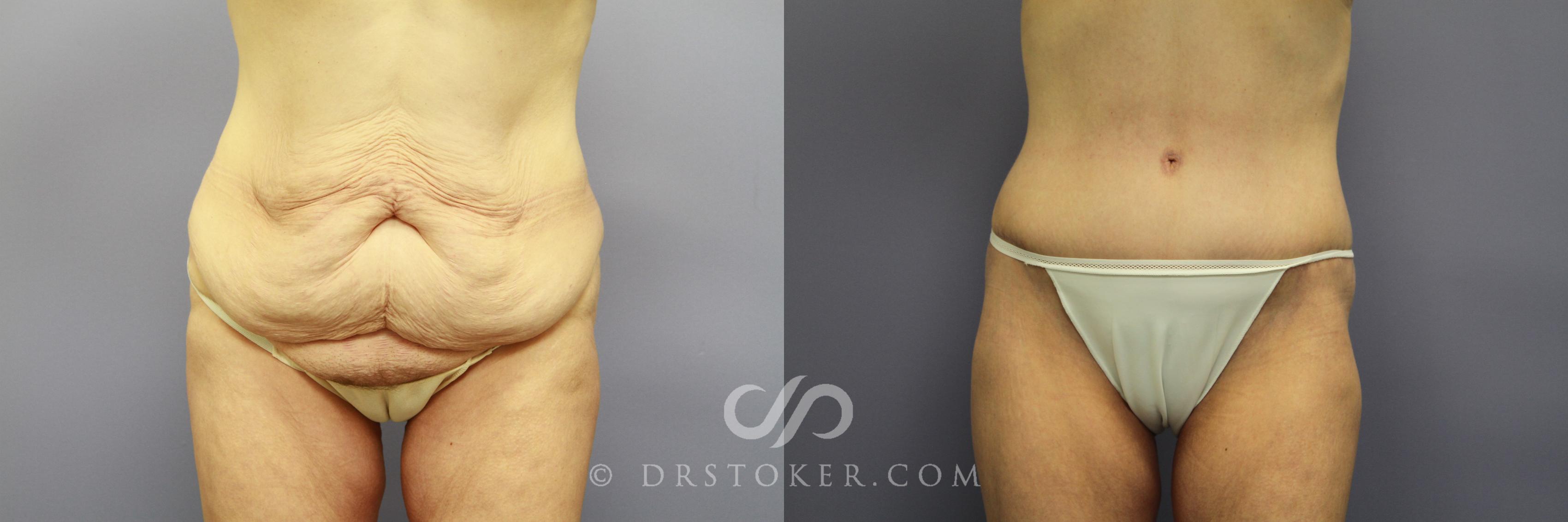 Before & After Tummy Tuck Case 773 View #1 View in Los Angeles, CA