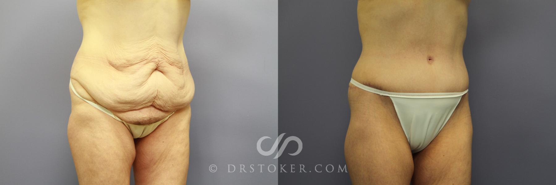 Before & After Tummy Tuck Case 773 View #2 View in Los Angeles, CA