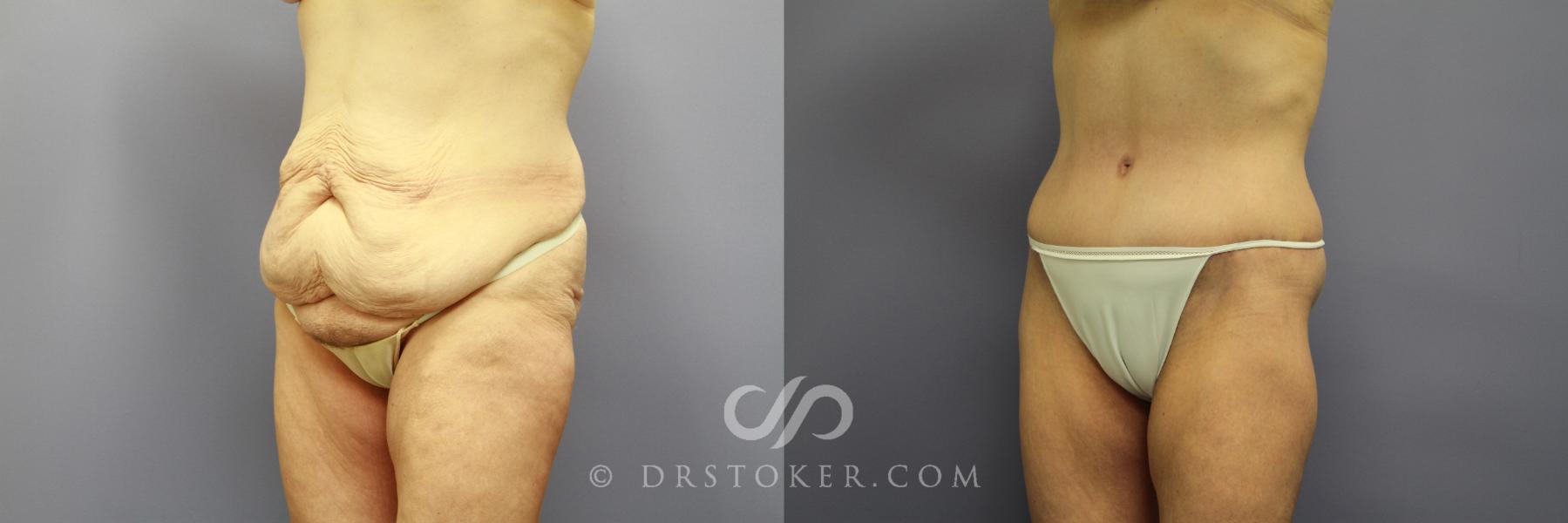 Before & After Tummy Tuck Case 773 View #5 View in Los Angeles, CA