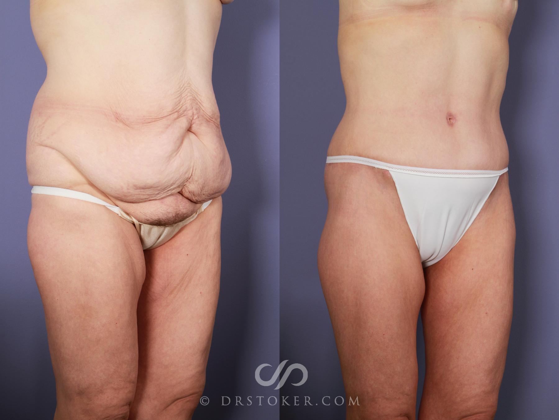 Before & After Tummy Tuck Case 774 View #2 View in Los Angeles, CA