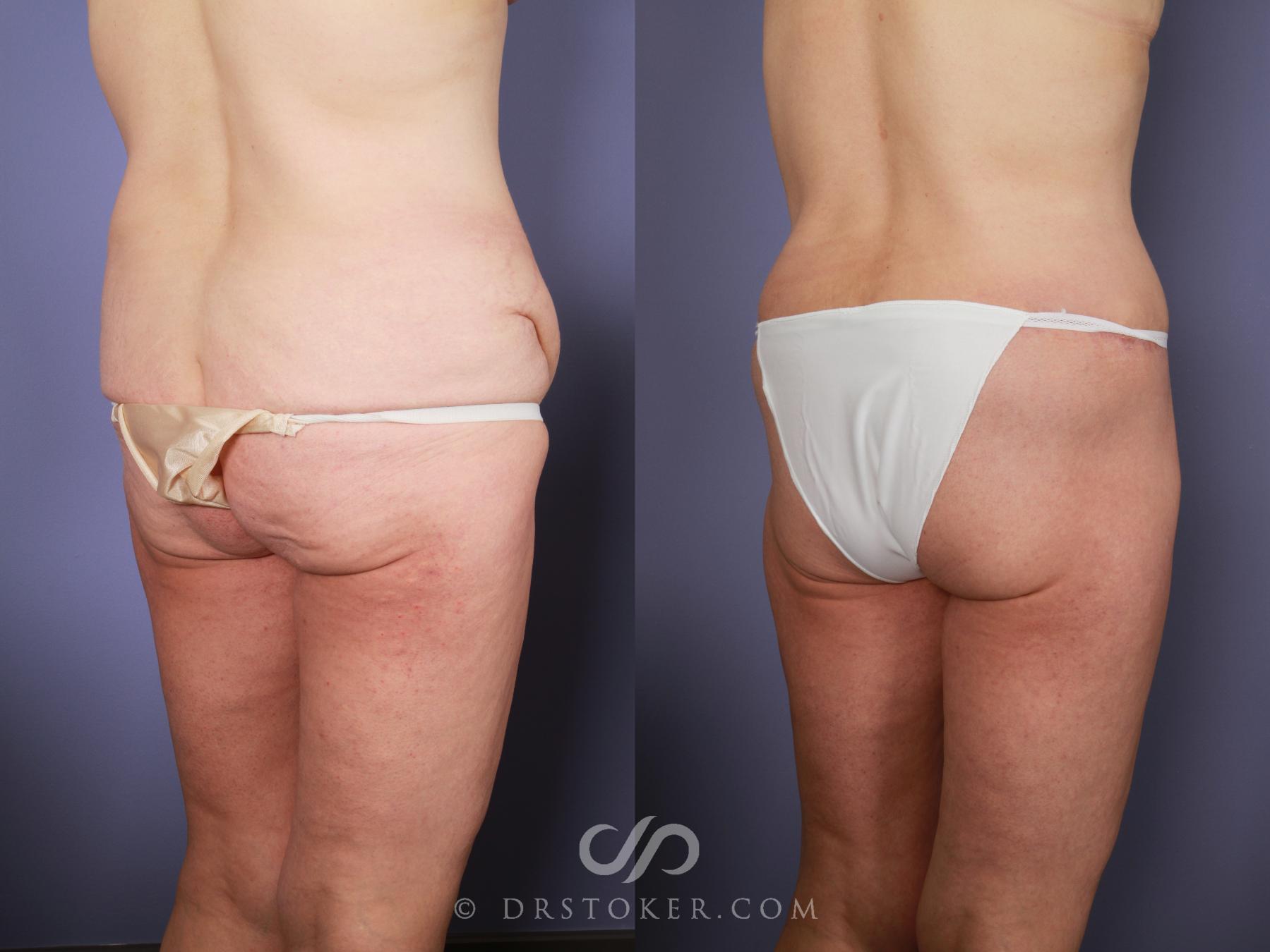Before & After Tummy Tuck Case 774 View #4 View in Los Angeles, CA