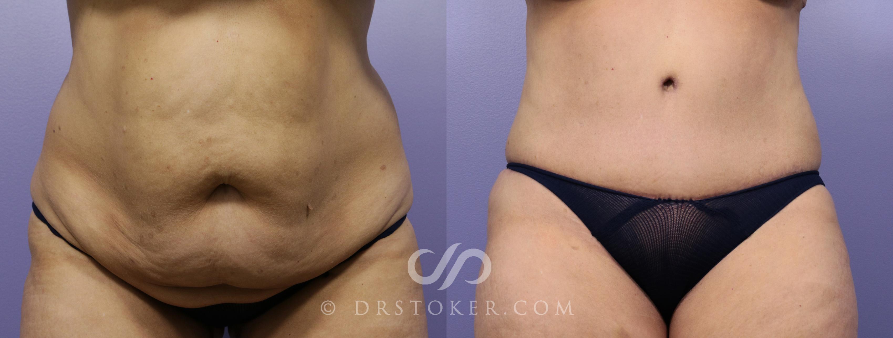 Before & After Tummy Tuck Case 777 View #1 View in Los Angeles, CA