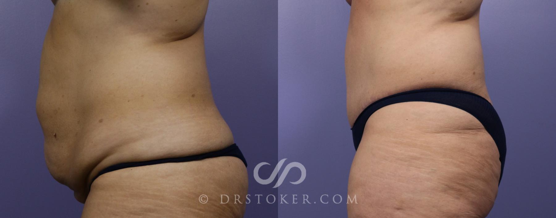 Before & After Tummy Tuck Case 777 View #3 View in Los Angeles, CA