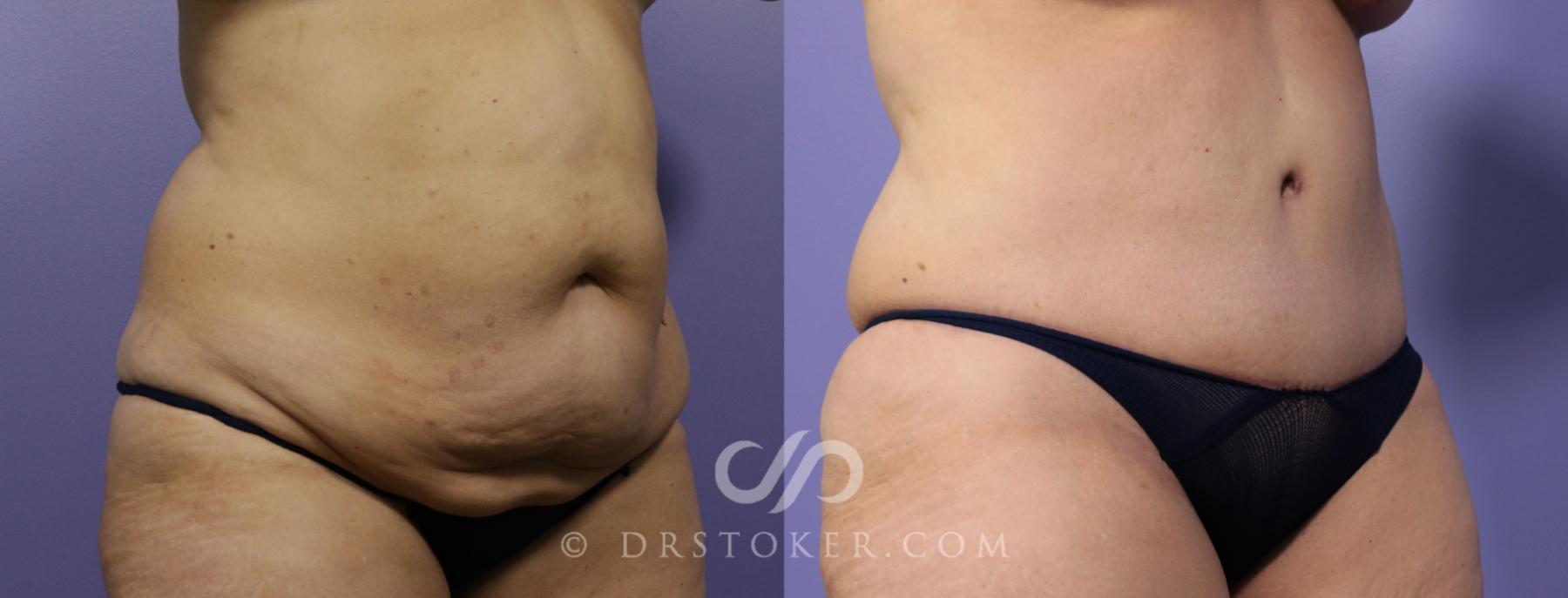 Before & After Tummy Tuck Case 777 View #4 View in Los Angeles, CA