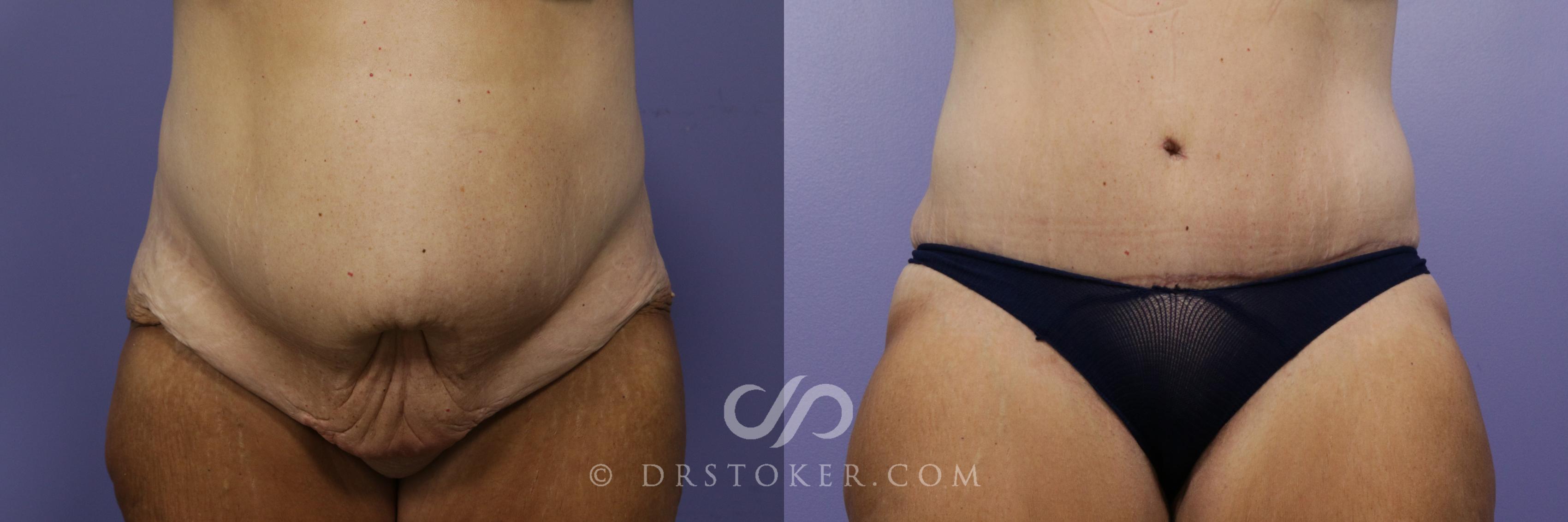Before & After Tummy Tuck Case 781 View #1 View in Los Angeles, CA