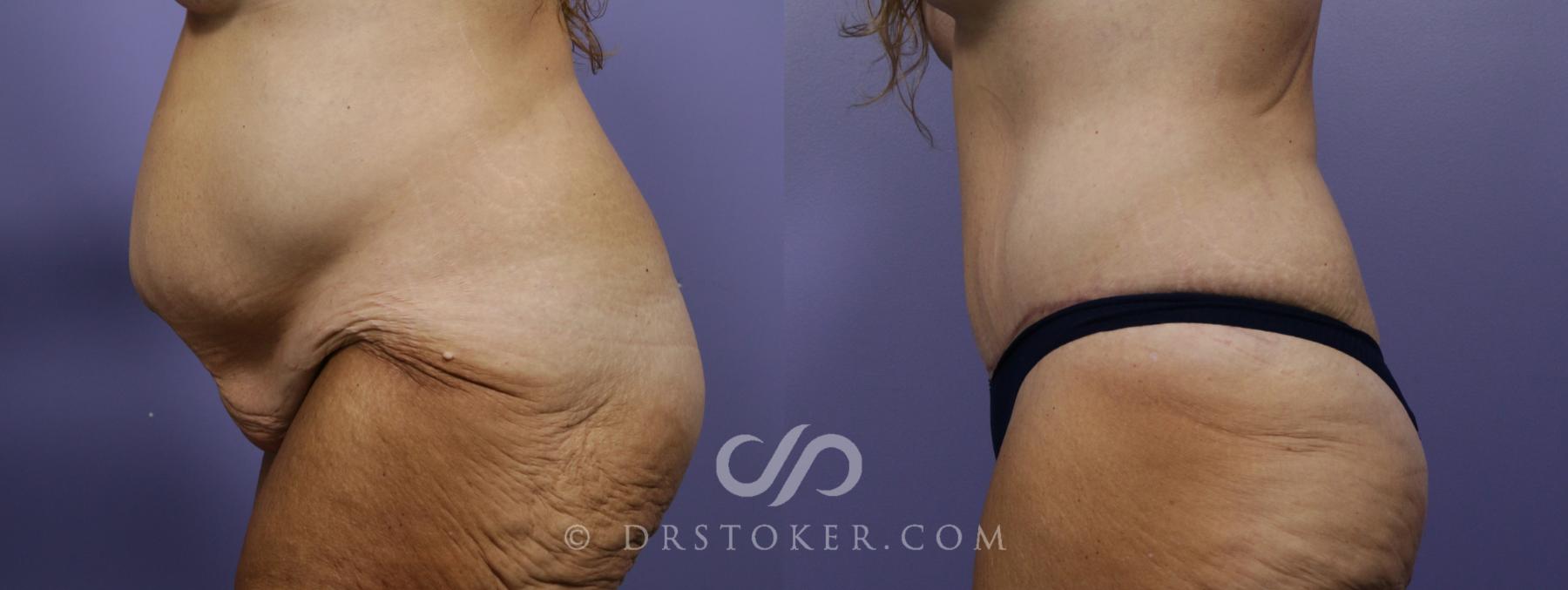 Before & After Tummy Tuck Case 781 View #2 View in Los Angeles, CA