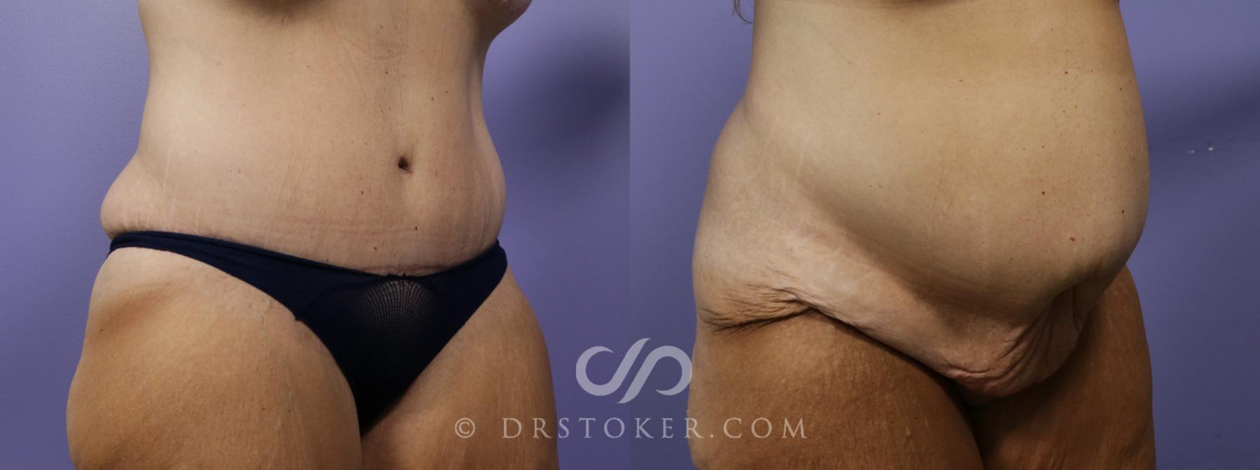 Before & After Tummy Tuck Case 781 View #3 View in Los Angeles, CA