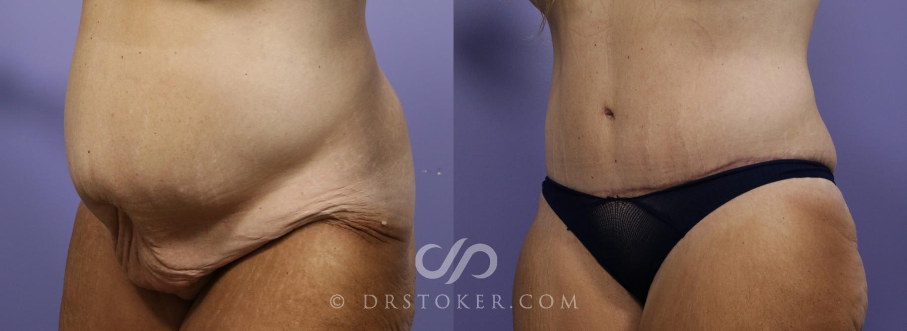 Before & After Tummy Tuck Case 781 View #5 View in Los Angeles, CA