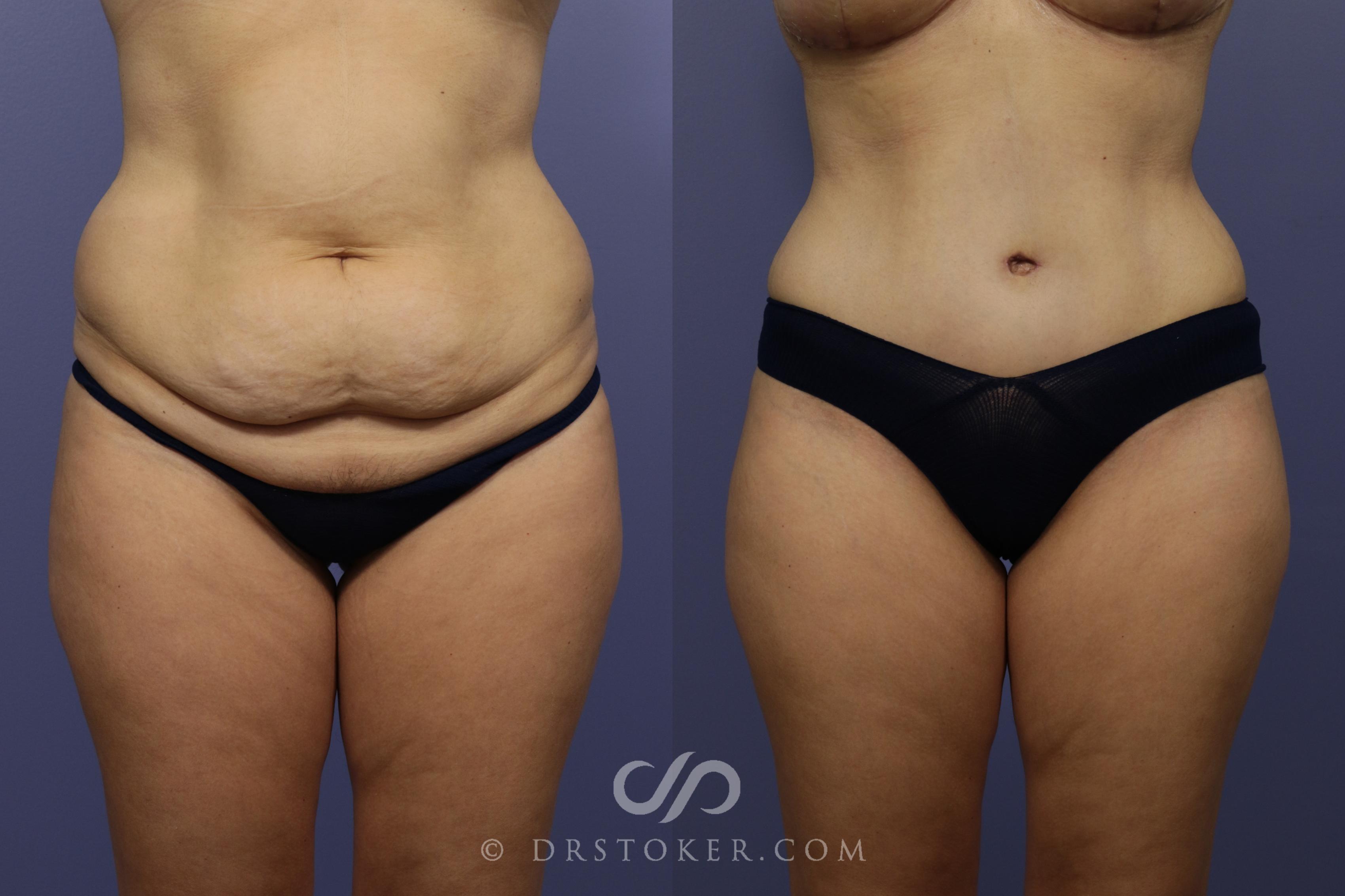 Before & After Tummy Tuck Case 788 View #1 View in Los Angeles, CA