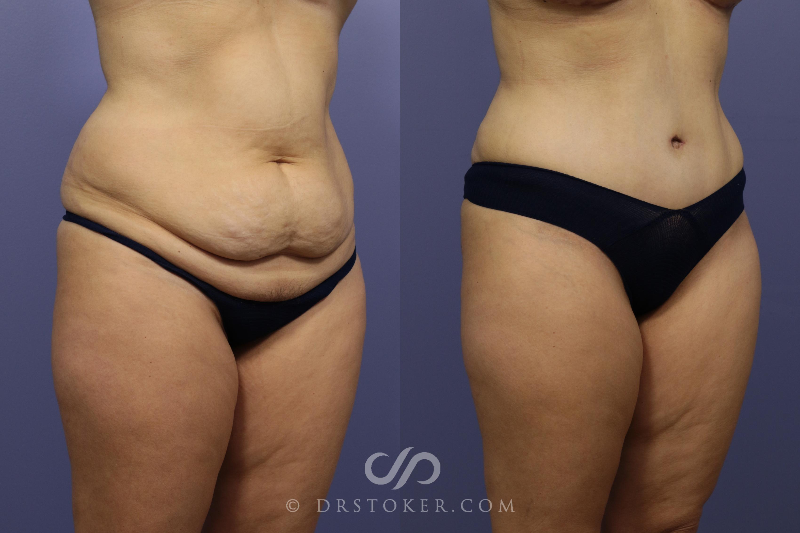 Before & After Tummy Tuck Case 788 View #3 View in Los Angeles, CA