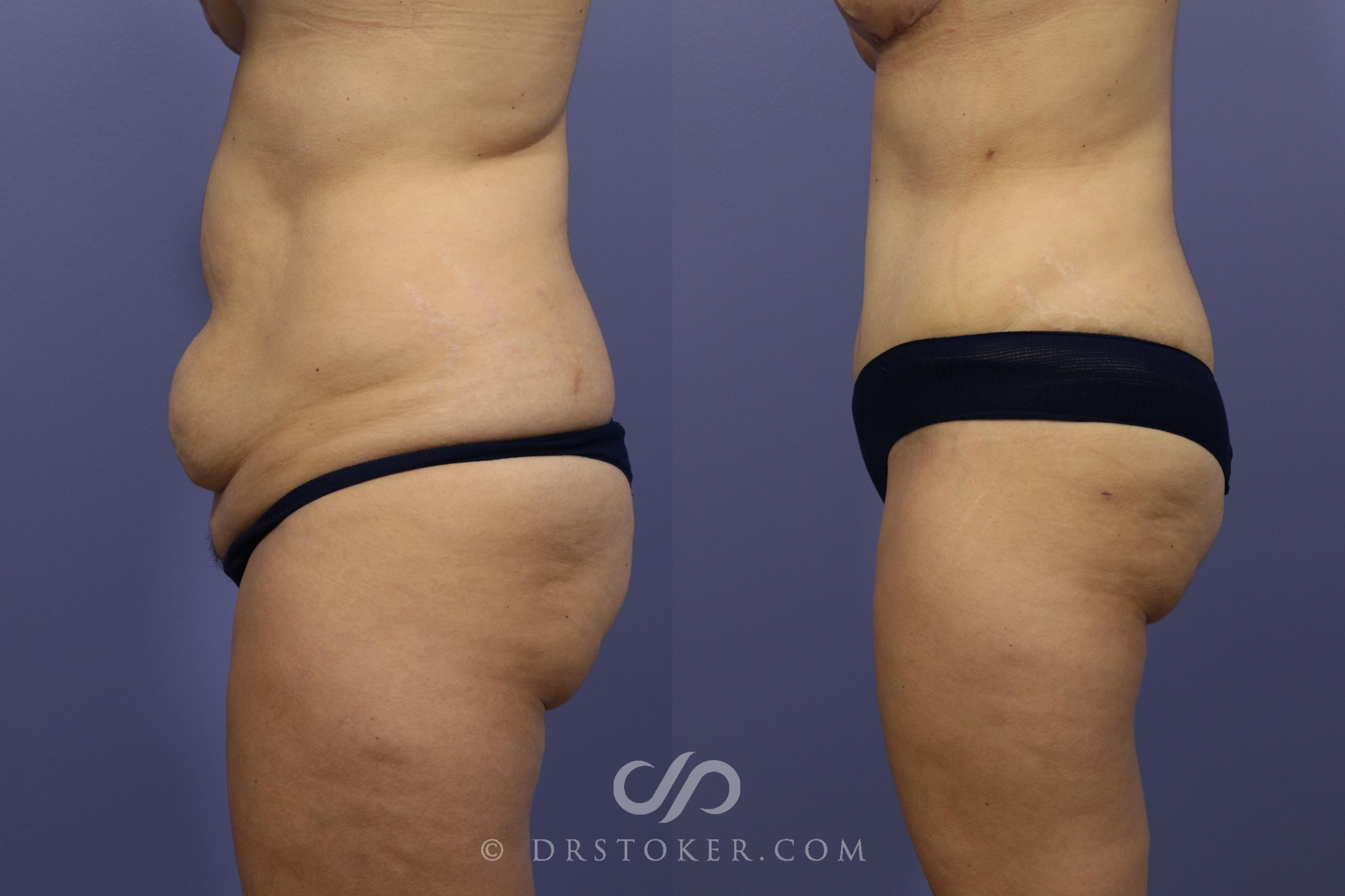 Before & After Tummy Tuck Case 788 View #4 View in Los Angeles, CA