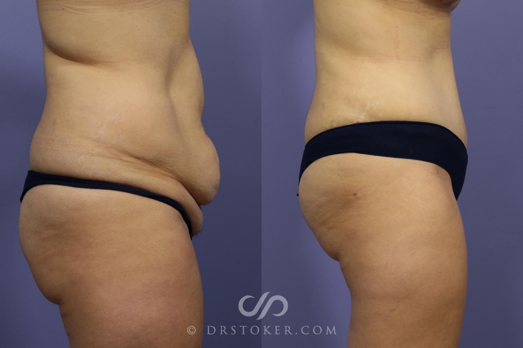 Before & After Tummy Tuck Case 788 View #5 View in Los Angeles, CA