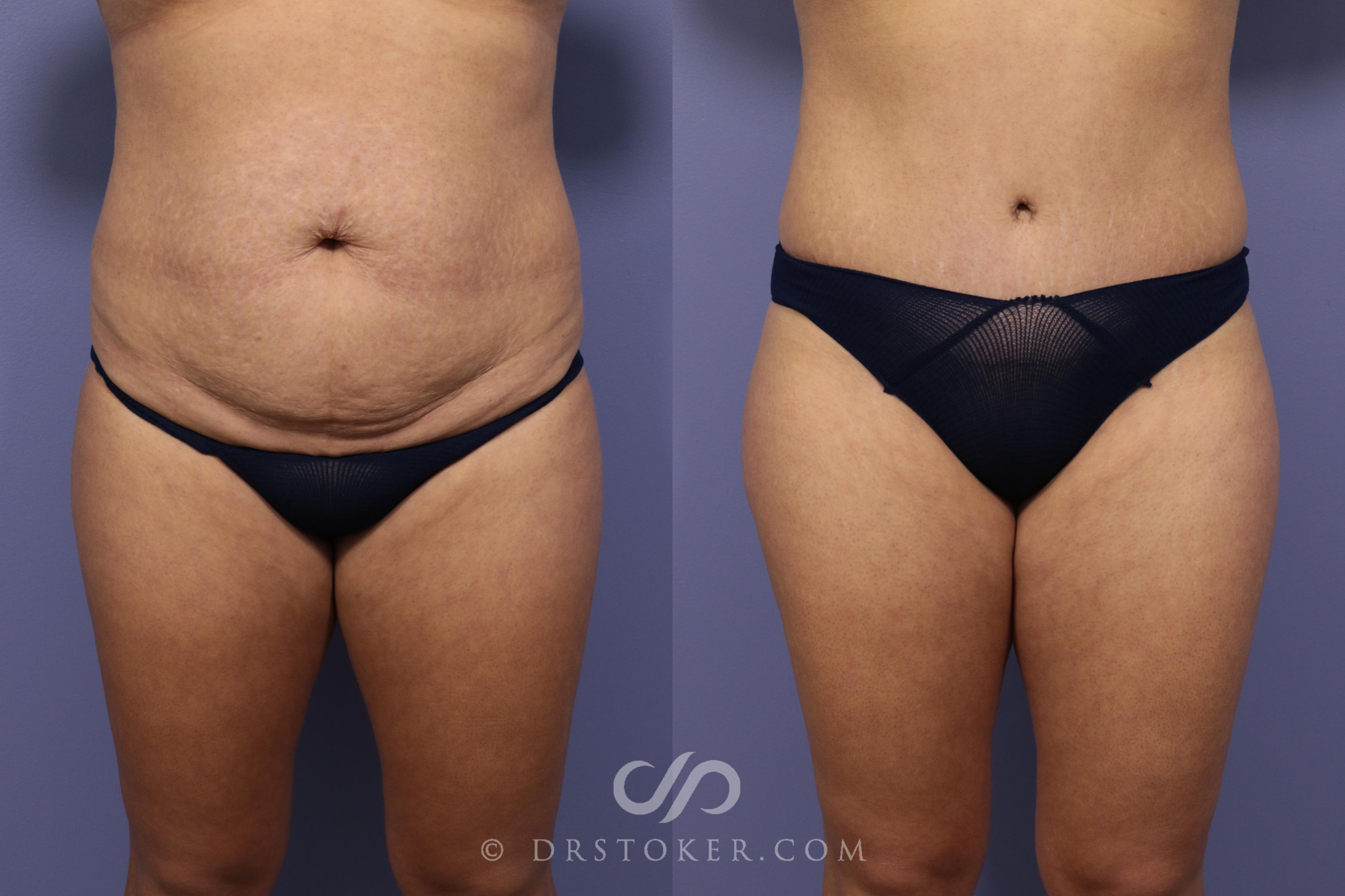 Before & After Tummy Tuck Case 789 View #1 View in Los Angeles, CA