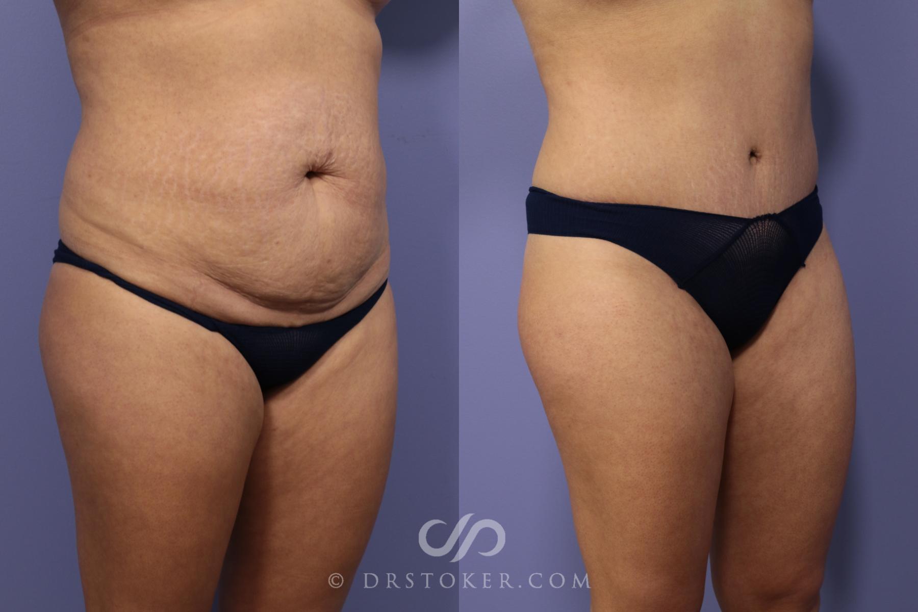 Before & After Tummy Tuck Case 789 View #2 View in Los Angeles, CA