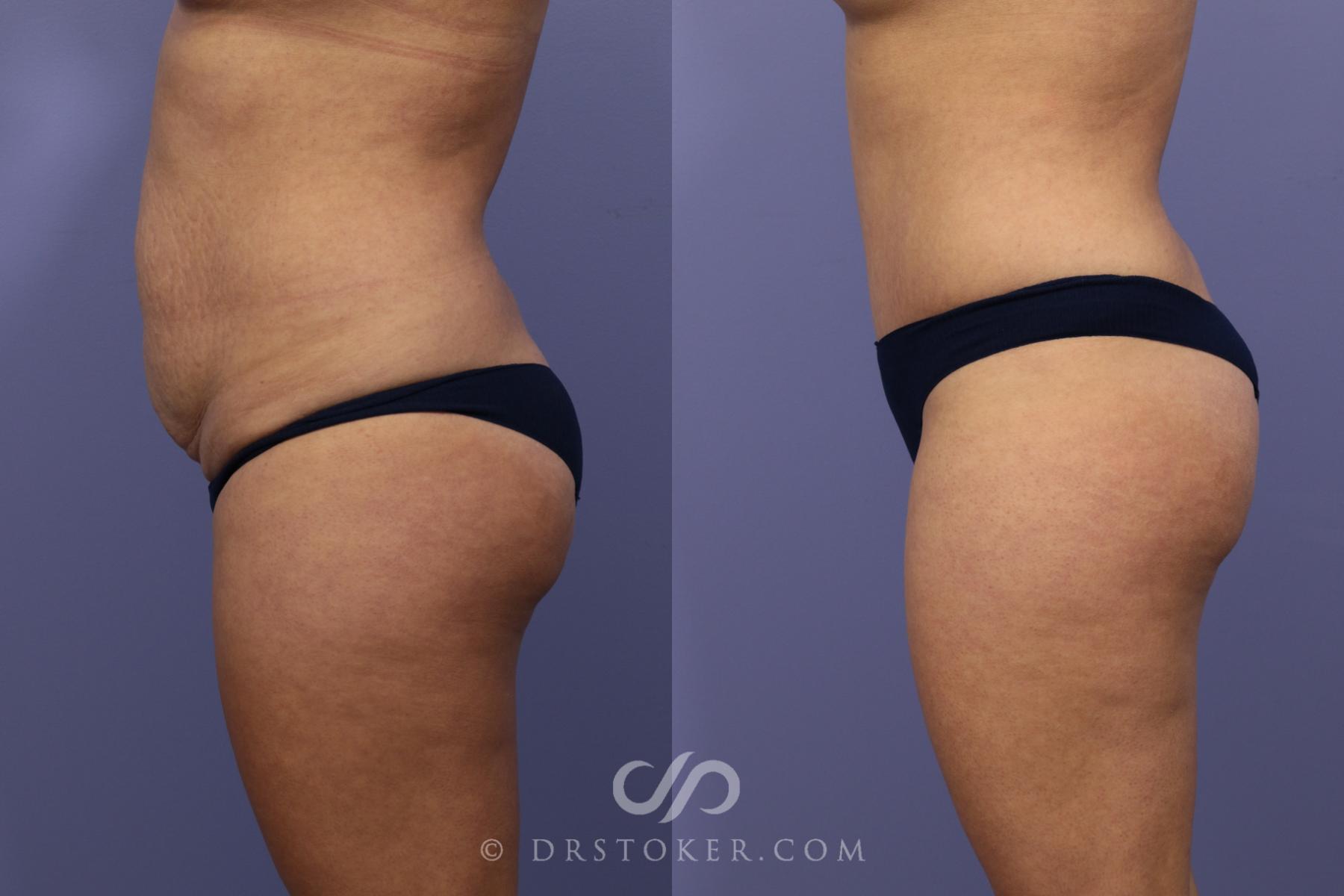 Before & After Tummy Tuck Case 789 View #3 View in Los Angeles, CA