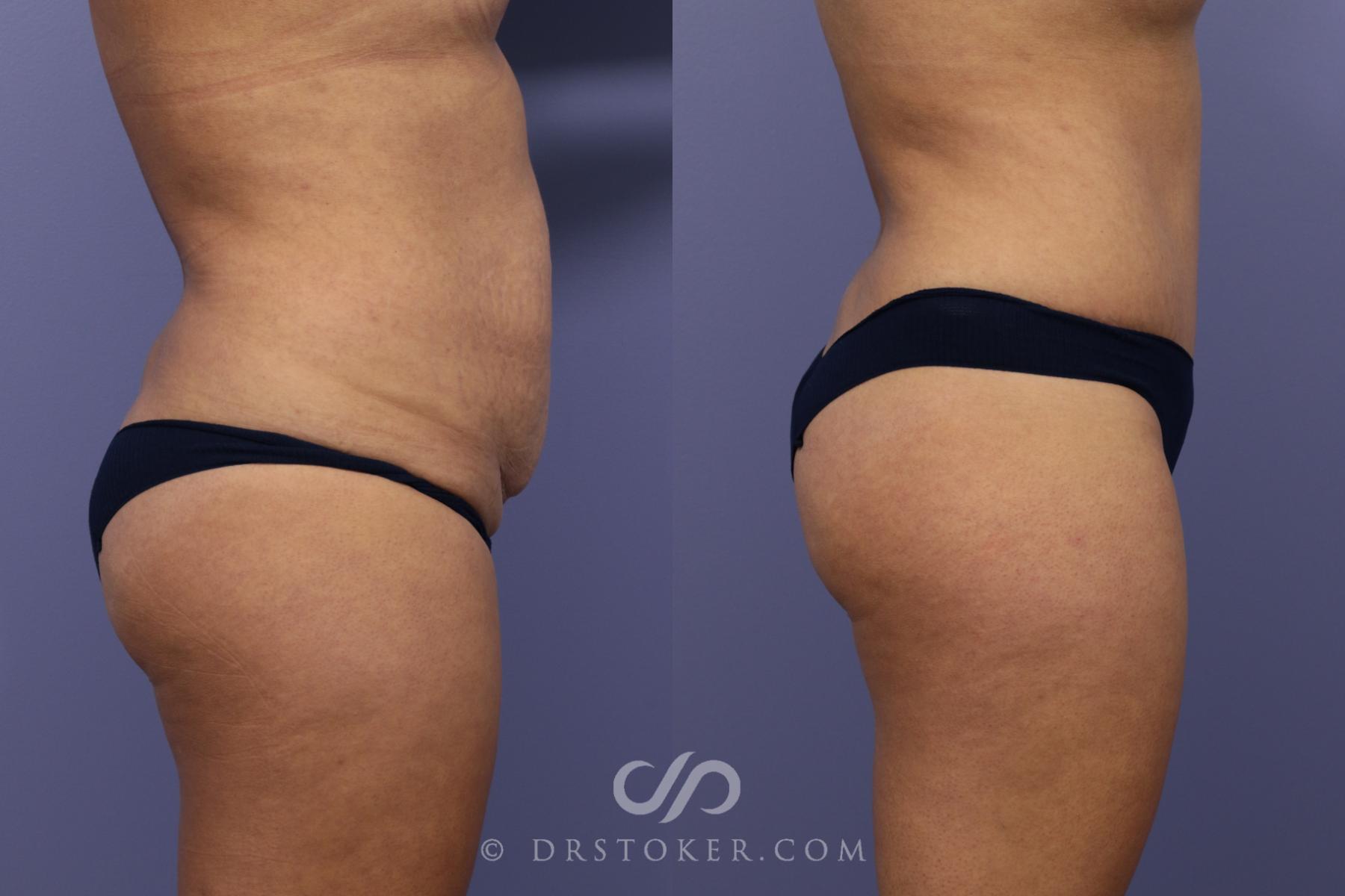 Before & After Tummy Tuck Case 789 View #4 View in Los Angeles, CA