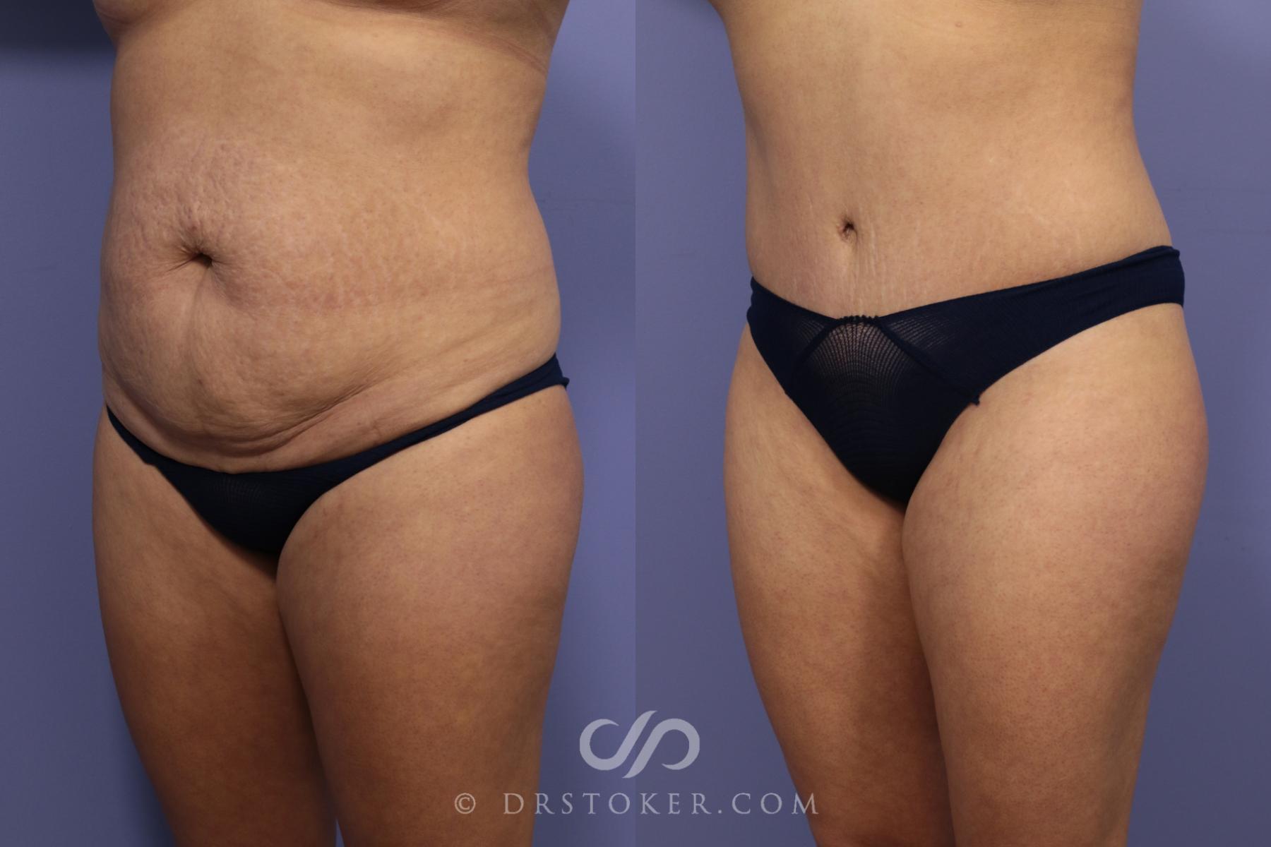 Before & After Tummy Tuck Case 789 View #5 View in Los Angeles, CA