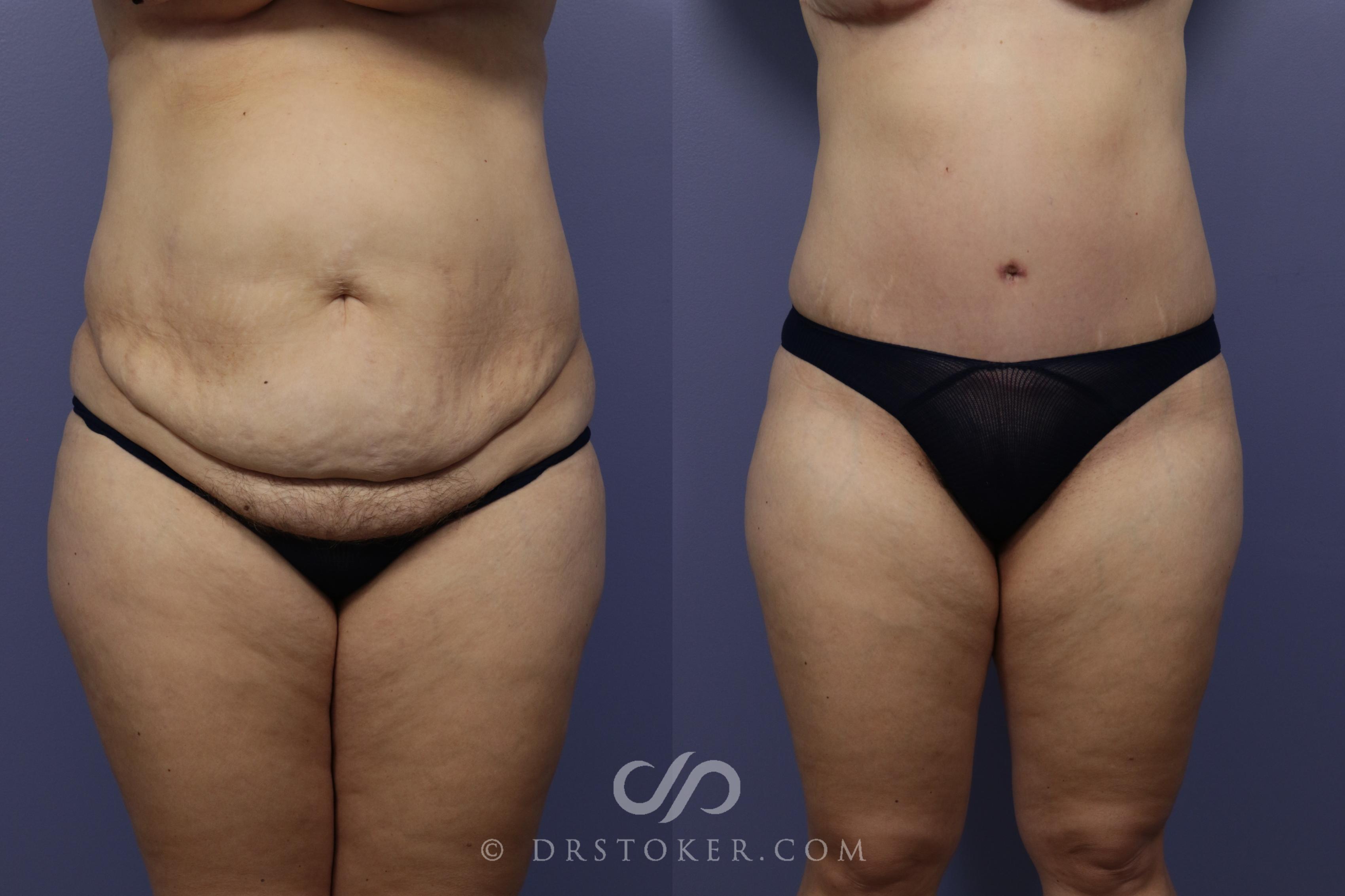 Before & After Tummy Tuck Case 790 View #1 View in Los Angeles, CA