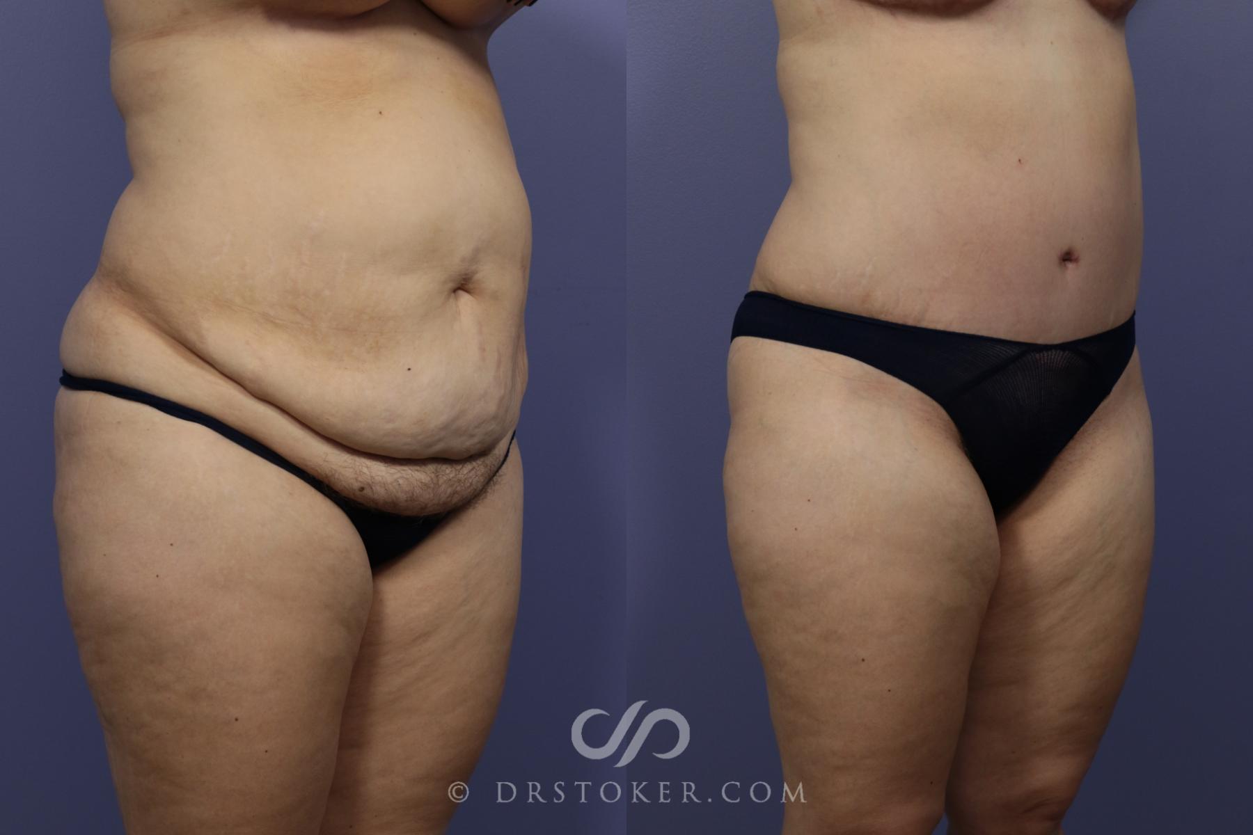 Before & After Tummy Tuck Case 790 View #2 View in Los Angeles, CA
