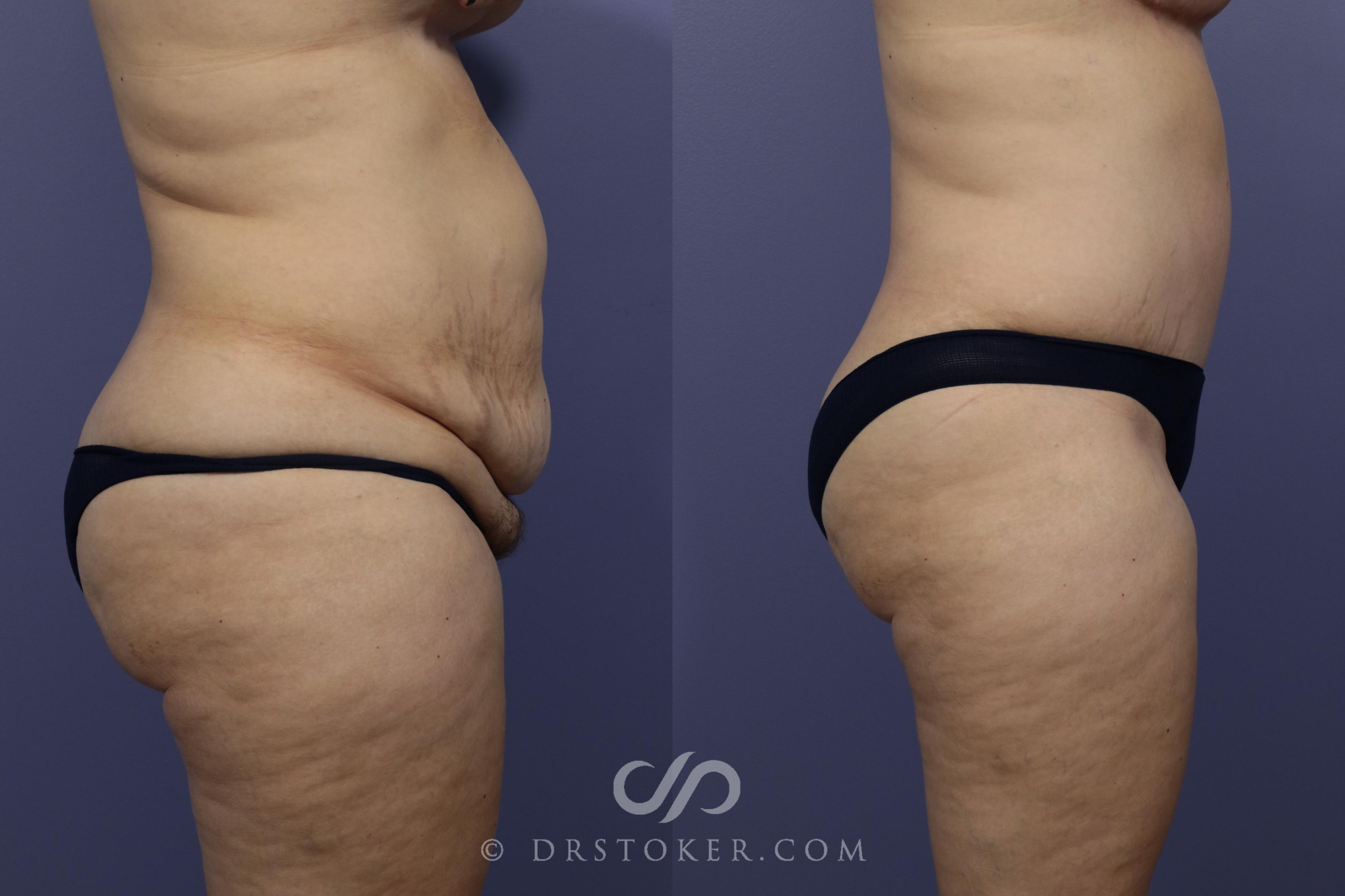 Before & After Tummy Tuck Case 790 View #3 View in Los Angeles, CA