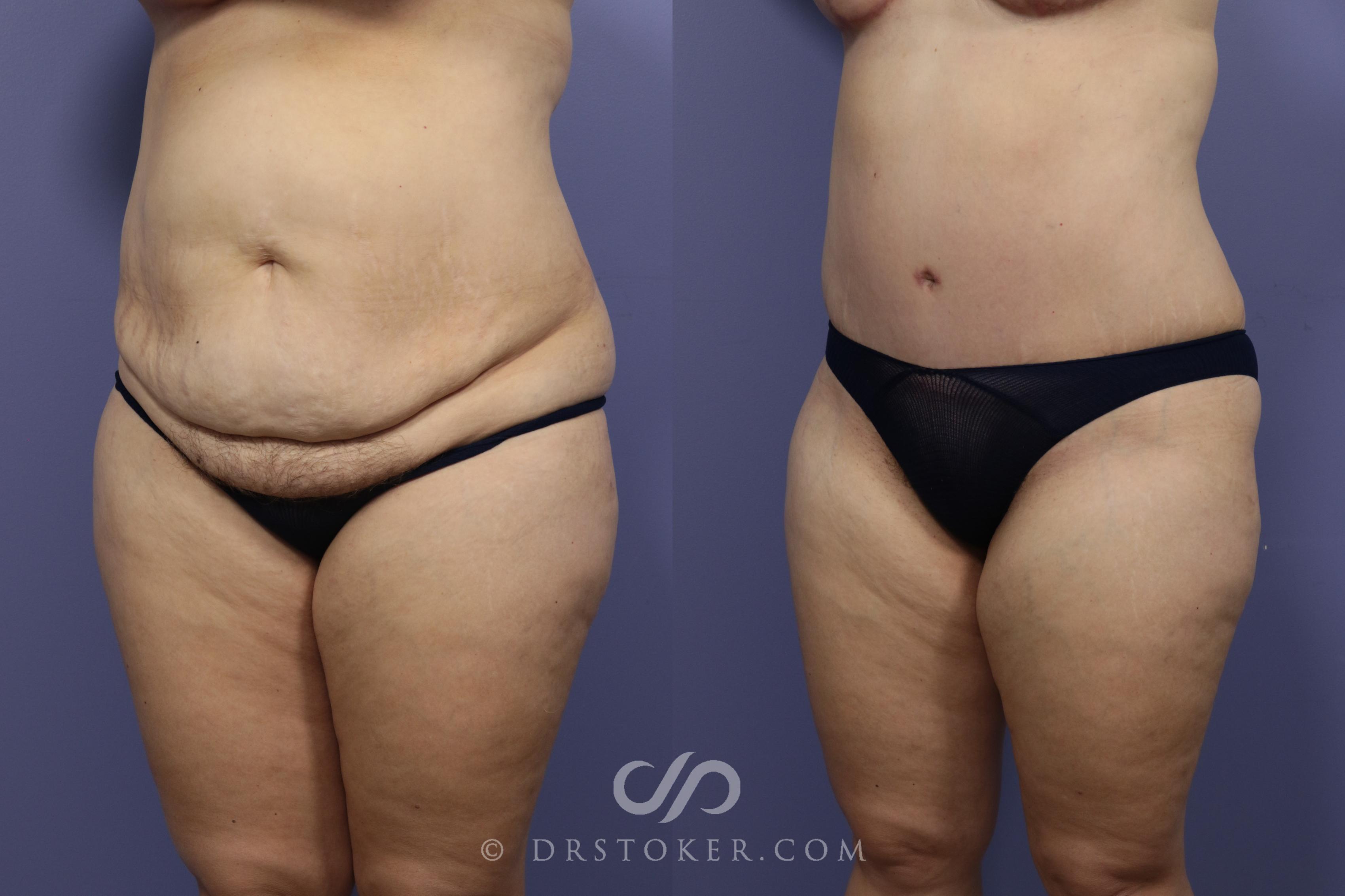 Before & After Tummy Tuck Case 790 View #4 View in Los Angeles, CA