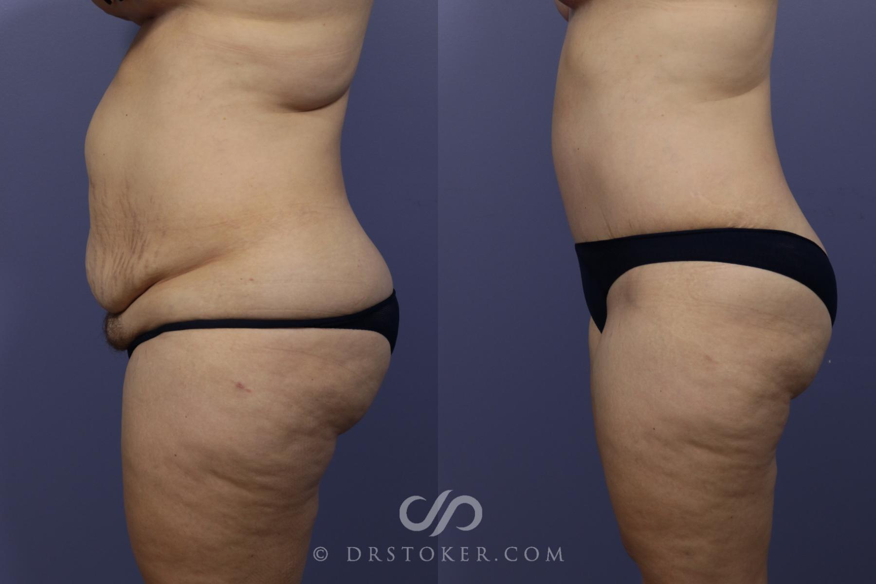 Before & After Tummy Tuck Case 790 View #5 View in Los Angeles, CA
