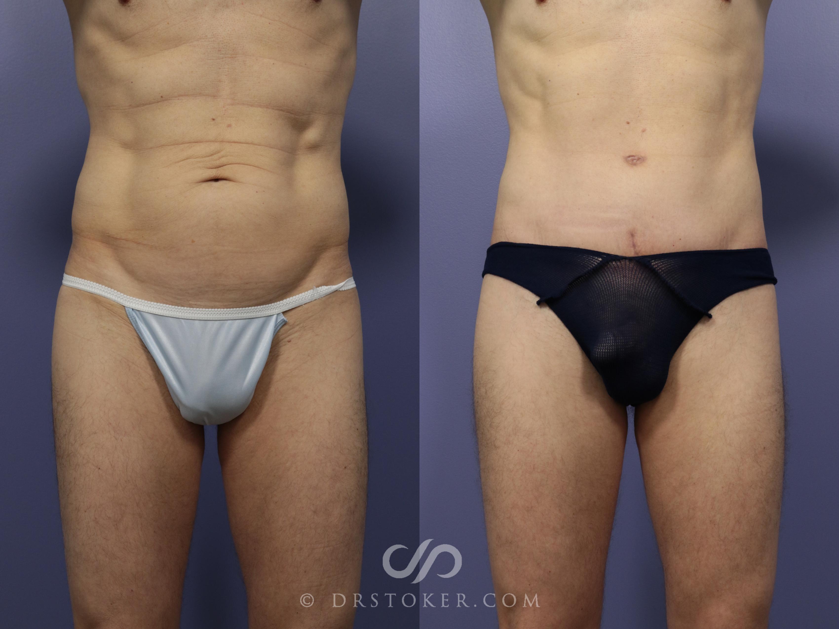 Before & After Tummy Tuck for Men Case 1182 View #1 View in Los Angeles, CA