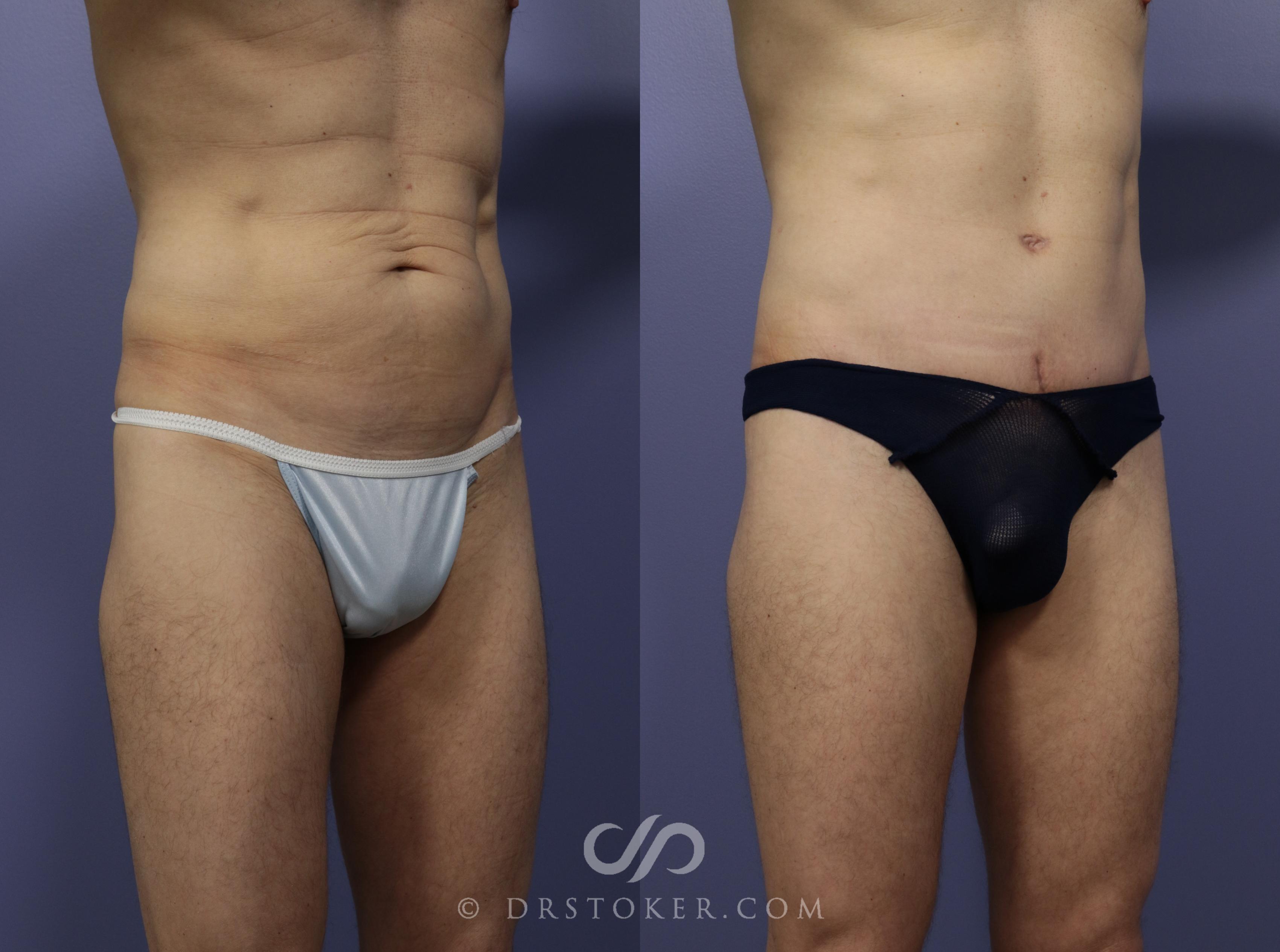 Before & After Tummy Tuck for Men Case 1182 View #2 View in Los Angeles, CA