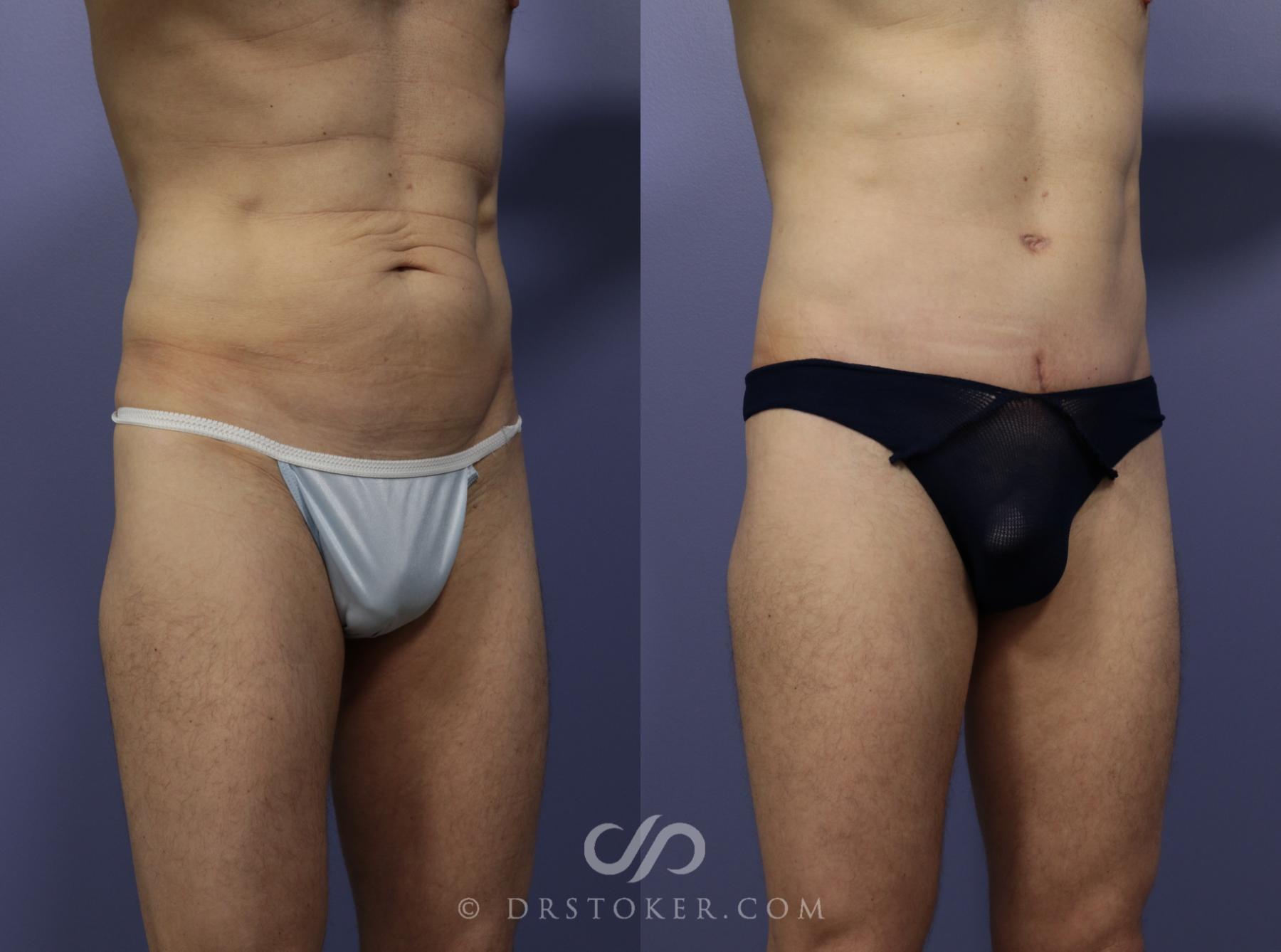 Before & After Tummy Tuck for Men Case 1182 View #2 View in Los Angeles, CA