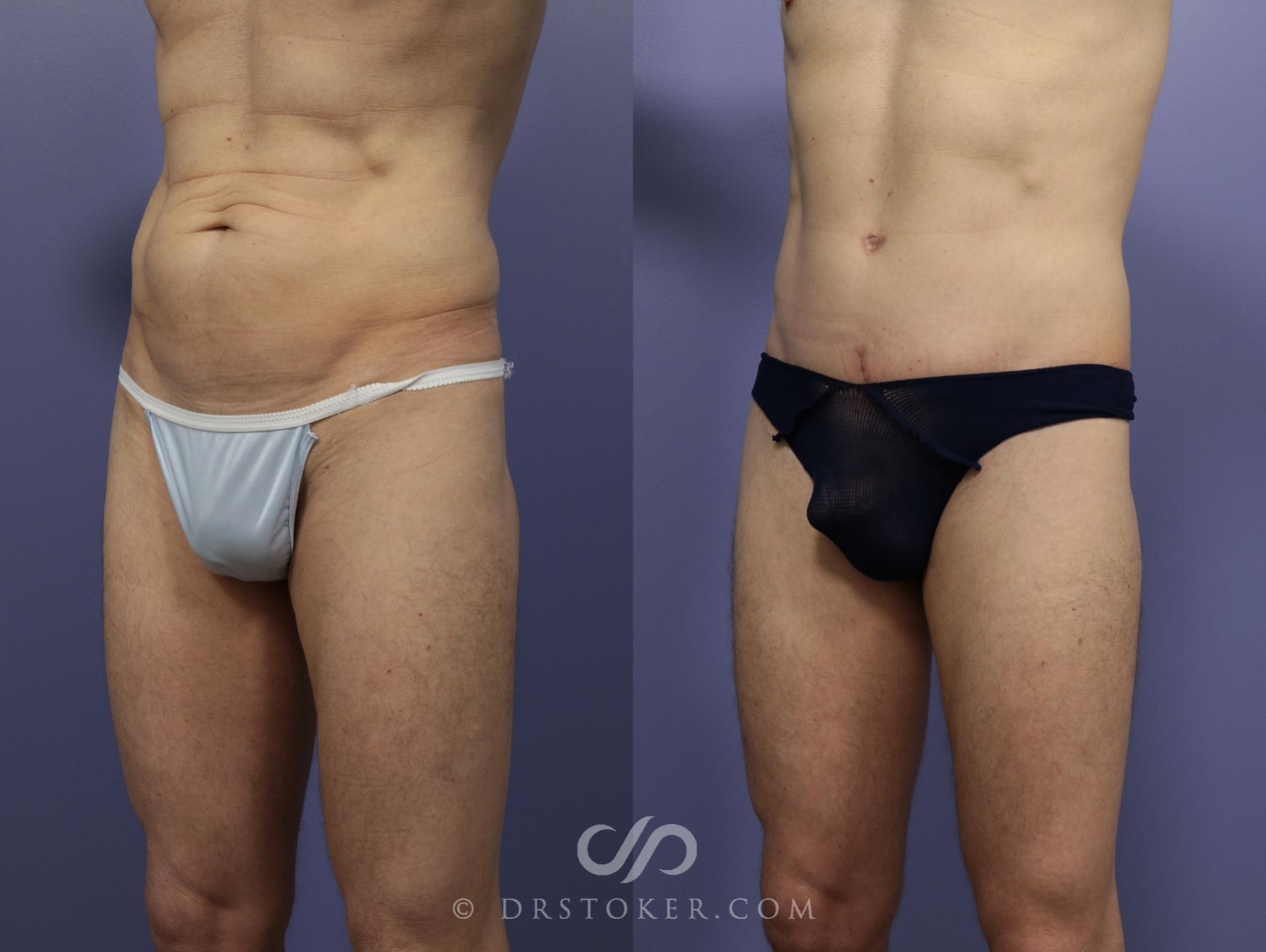 Before & After Tummy Tuck for Men Case 1182 View #3 View in Los Angeles, CA