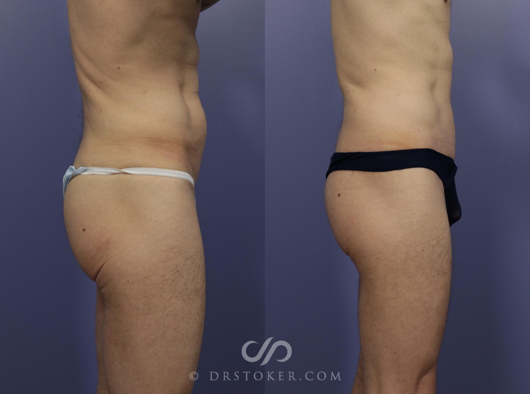 Before & After Tummy Tuck for Men Case 1182 View #4 View in Los Angeles, CA