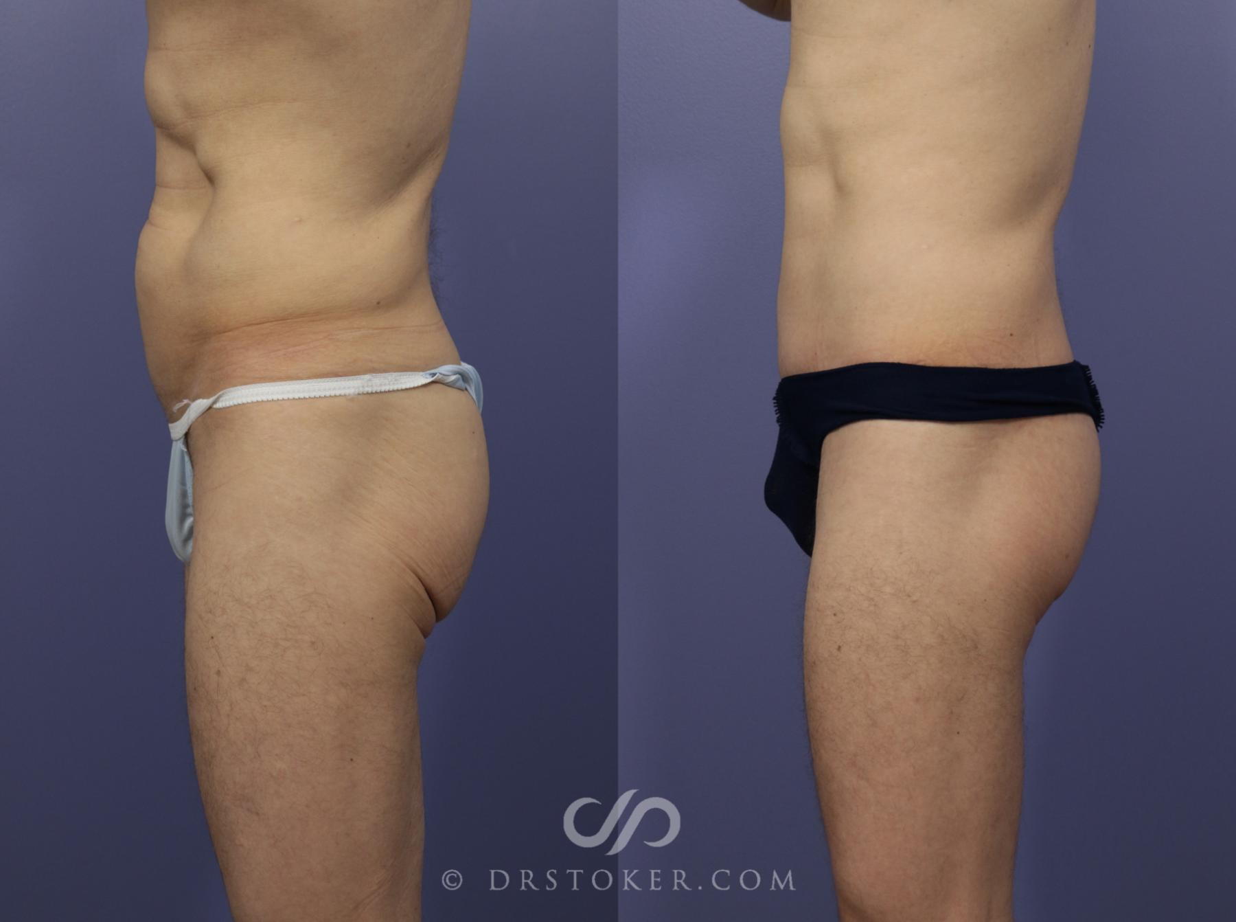 Before & After Tummy Tuck for Men Case 1182 View #5 View in Los Angeles, CA