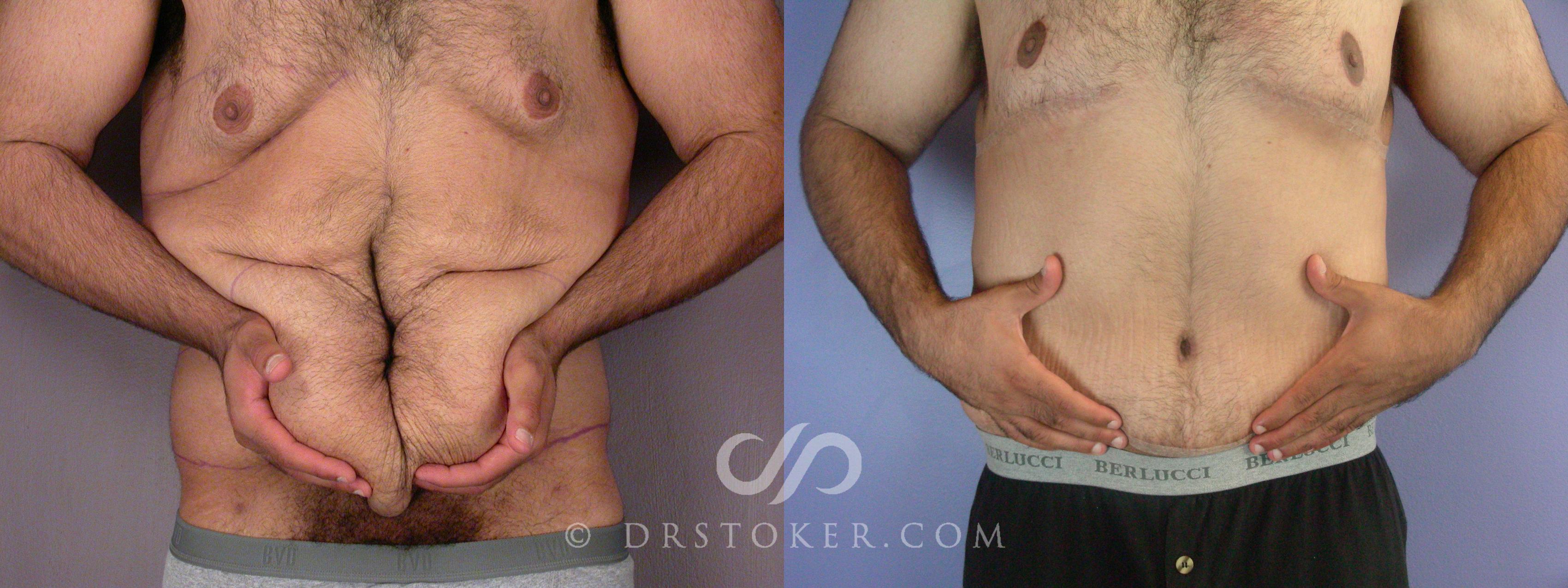 One day after tummy tuck surgery with compression garnent and surgical  drain tubes - Tummy Tuck for Men - Tummy Tuck For Men / Male Tummy Tuck