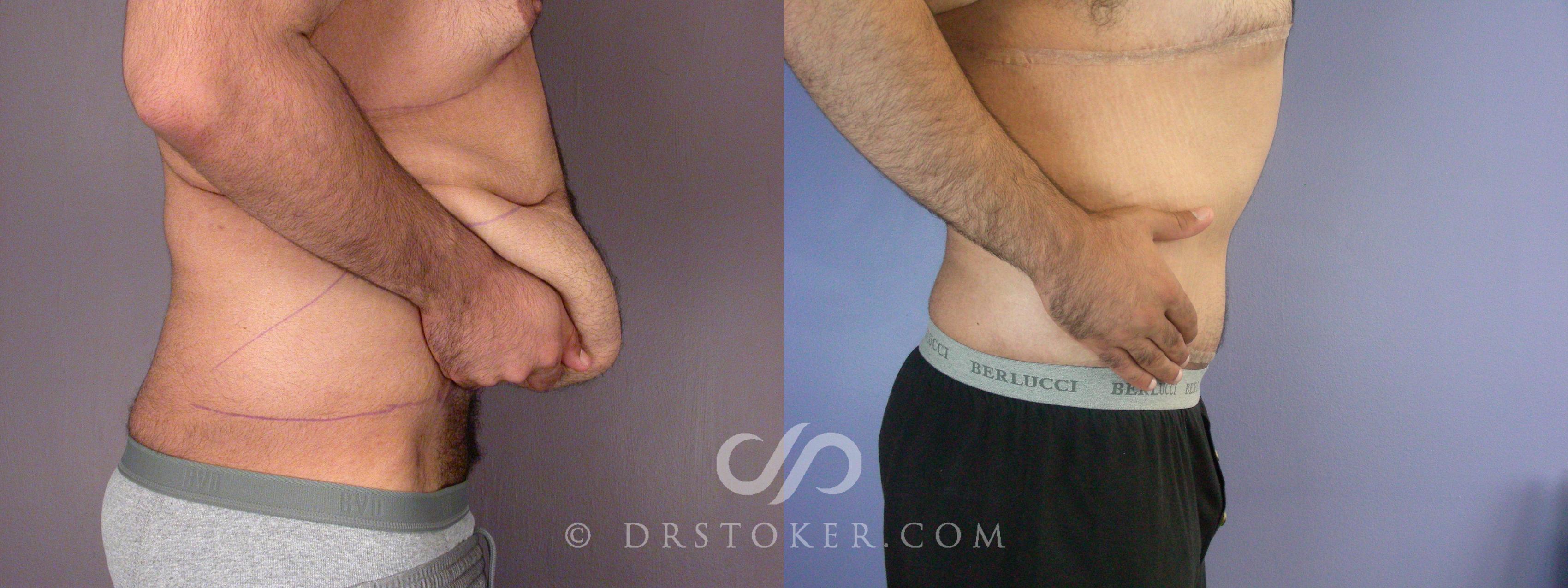 Before & After Tummy Tuck Case 1763 View #1 View in Los Angeles, CA