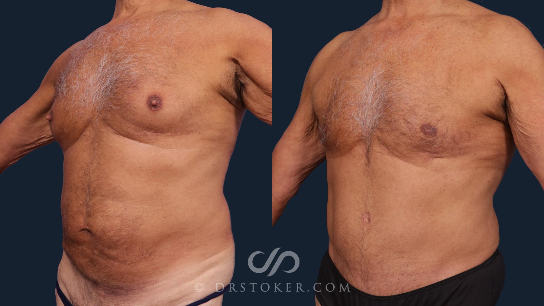 Before & After Tummy Tuck for Men Case 2007 Left Oblique View in Los Angeles, CA