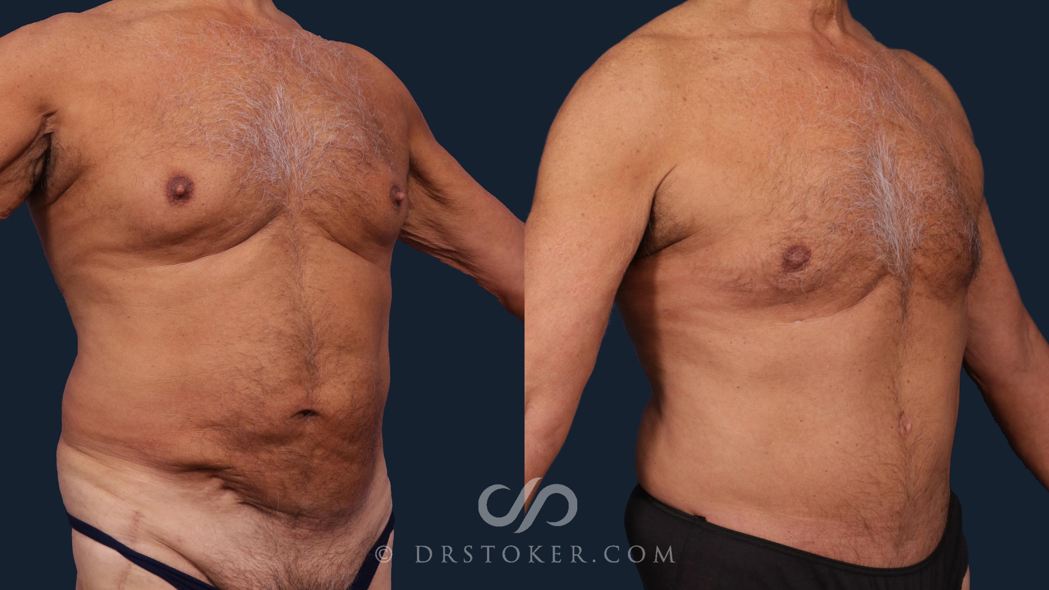 Before & After Tummy Tuck for Men Case 2008 Right Oblique View in Los Angeles, CA