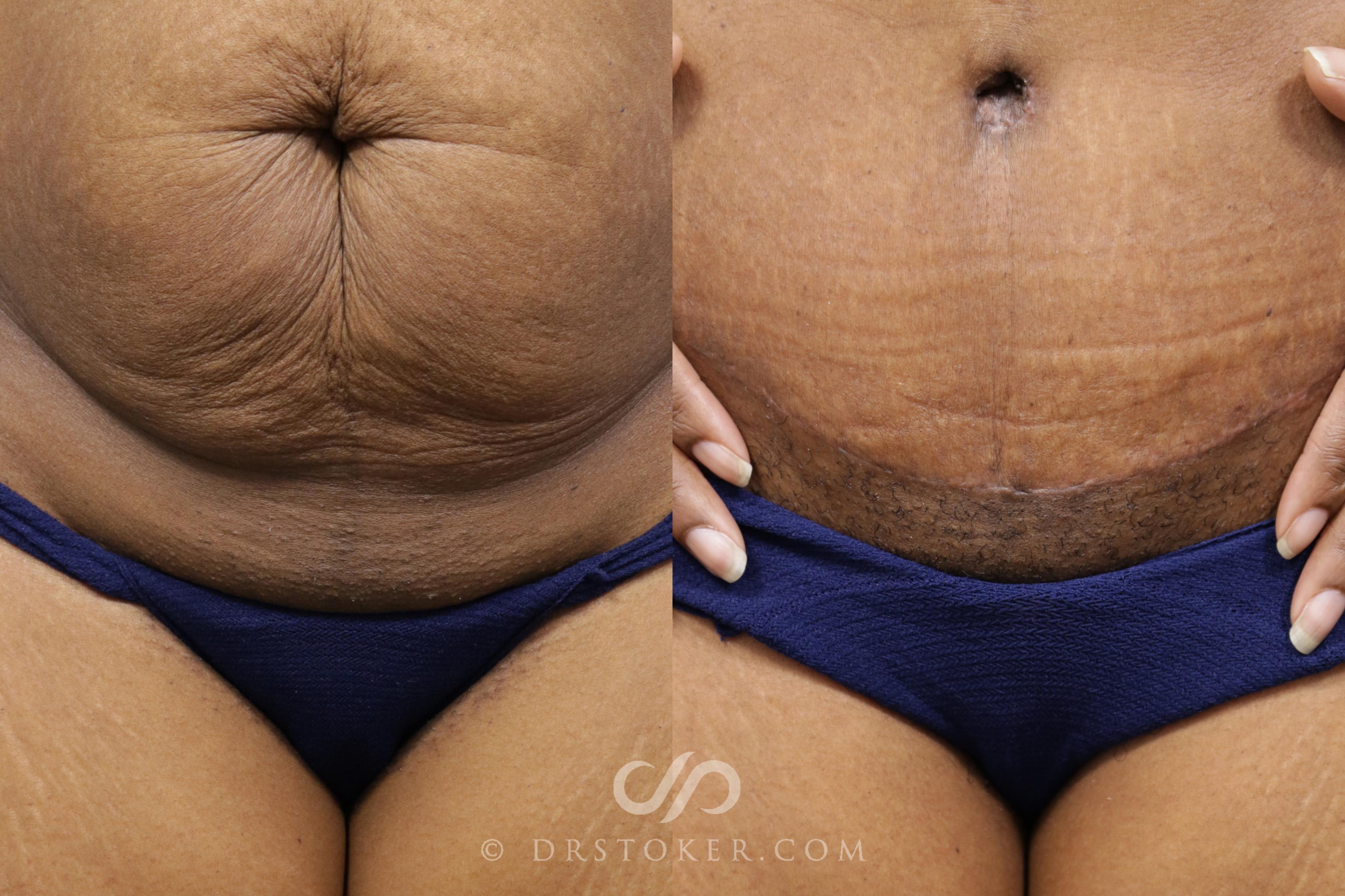 Before & After Tummy Tuck Scars  Case 1569 View #1 View in Los Angeles, CA