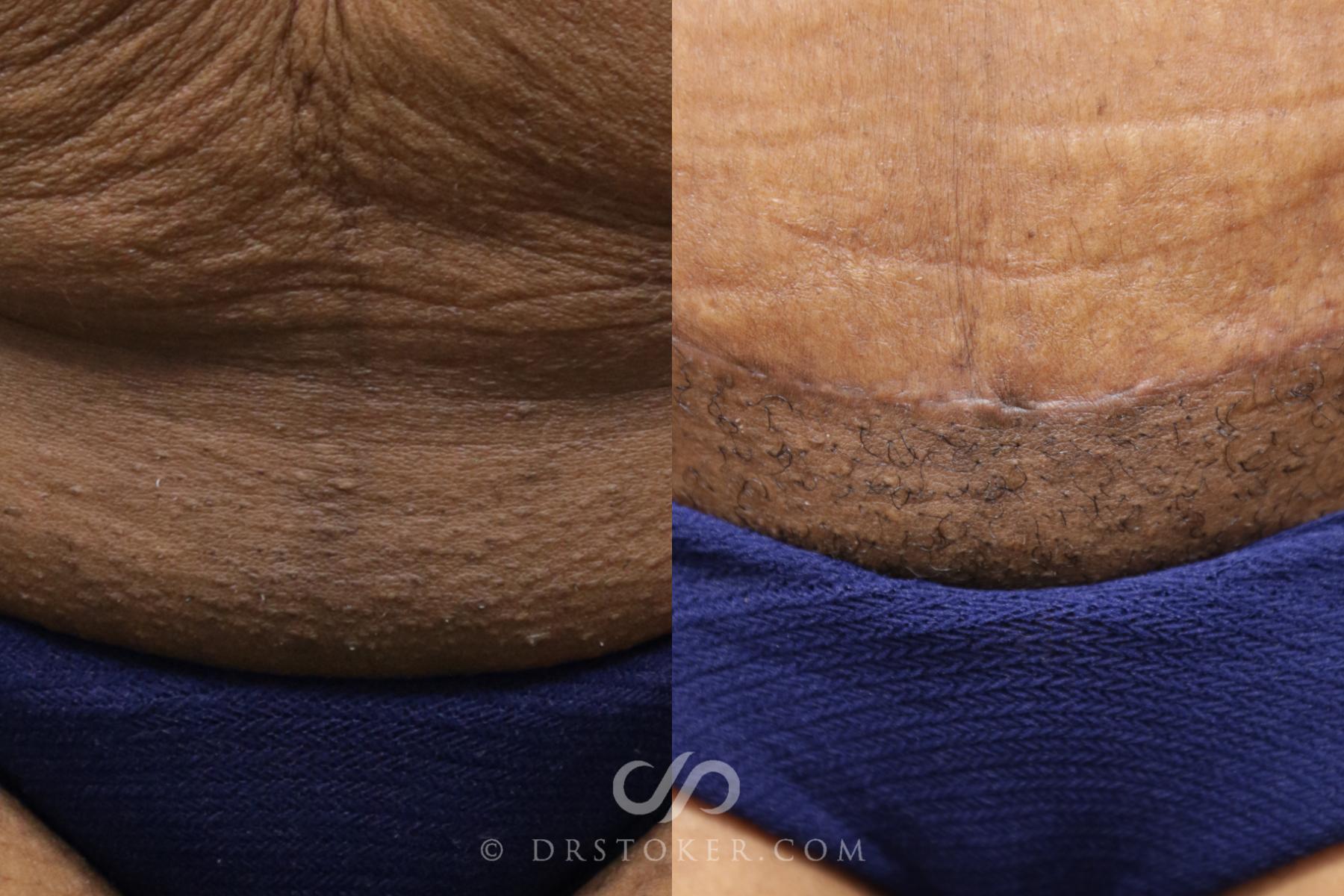 Before & After Tummy Tuck Scars  Case 1569 View #2 View in Los Angeles, CA