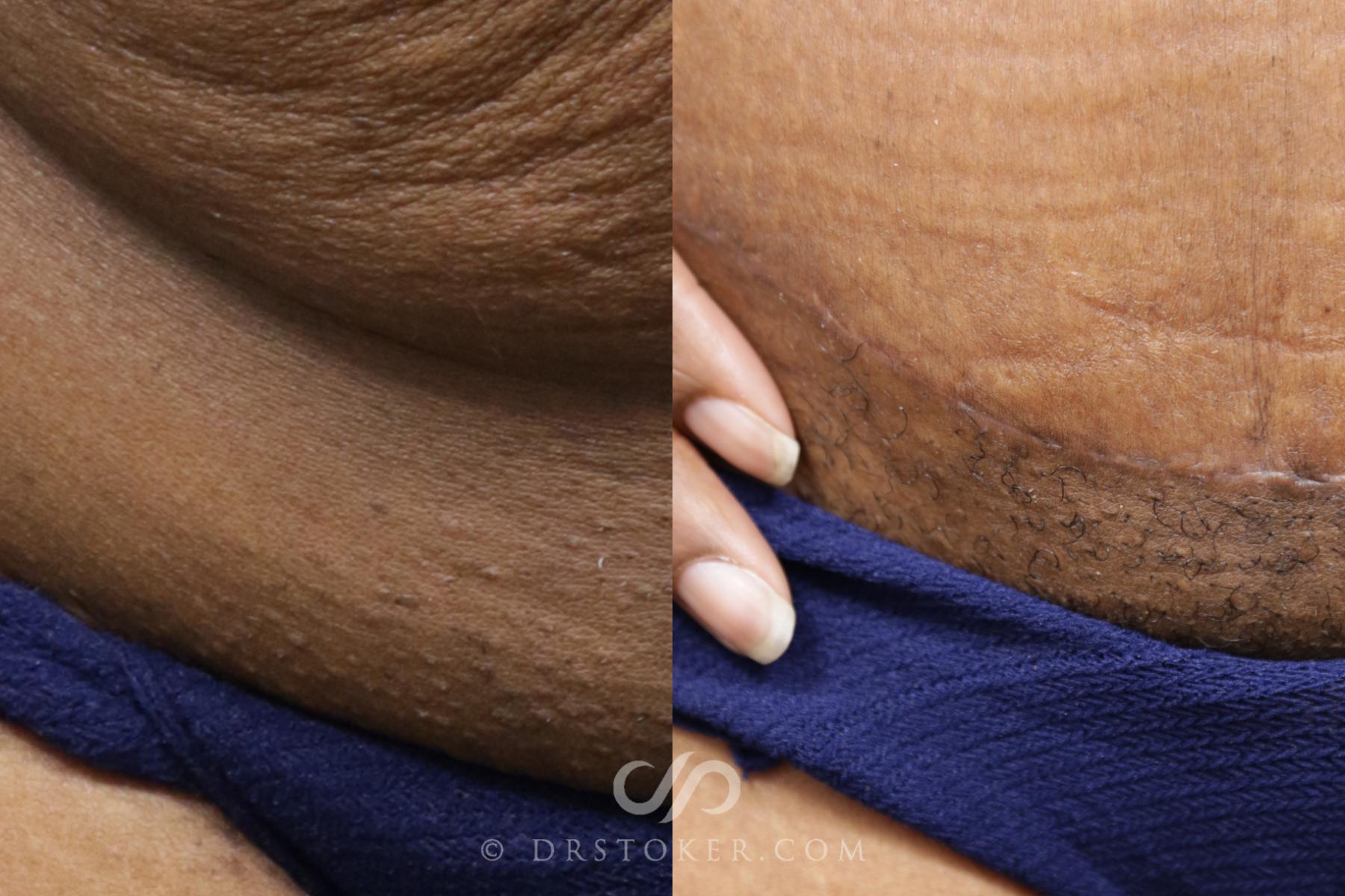 Before & After Tummy Tuck Scars  Case 1569 View #3 View in Los Angeles, CA