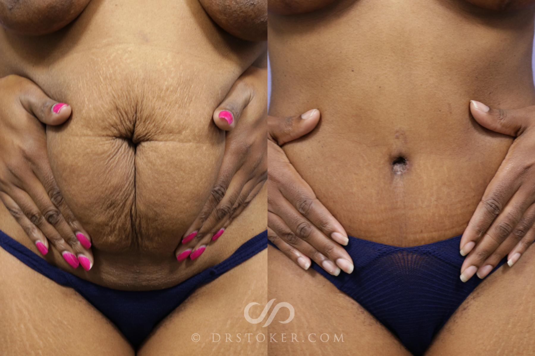 Before & After Tummy Tuck Scars  Case 1569 View #4 View in Los Angeles, CA