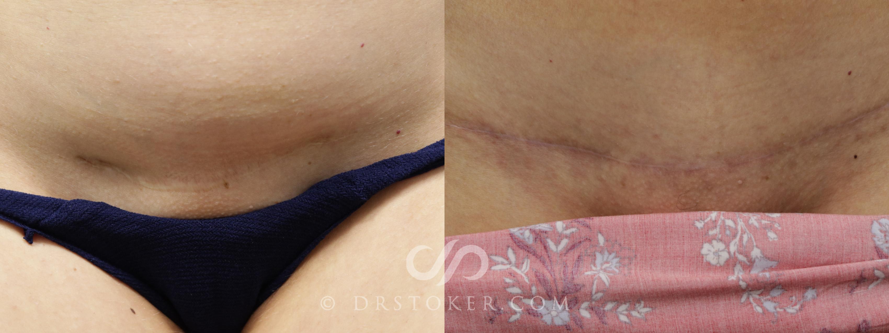 Before & After Tummy Tuck Scars  Case 1574 View #1 View in Los Angeles, CA