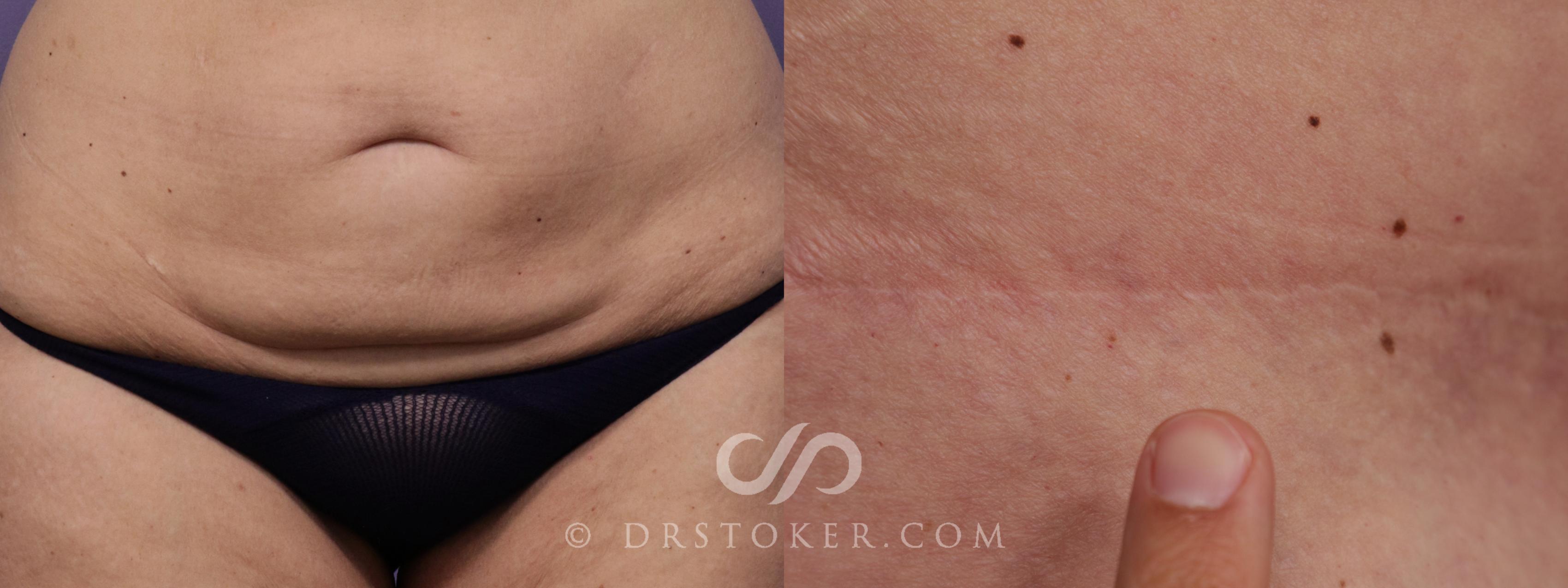 Before & After Tummy Tuck Scars  Case 1684 View #1 View in Los Angeles, CA
