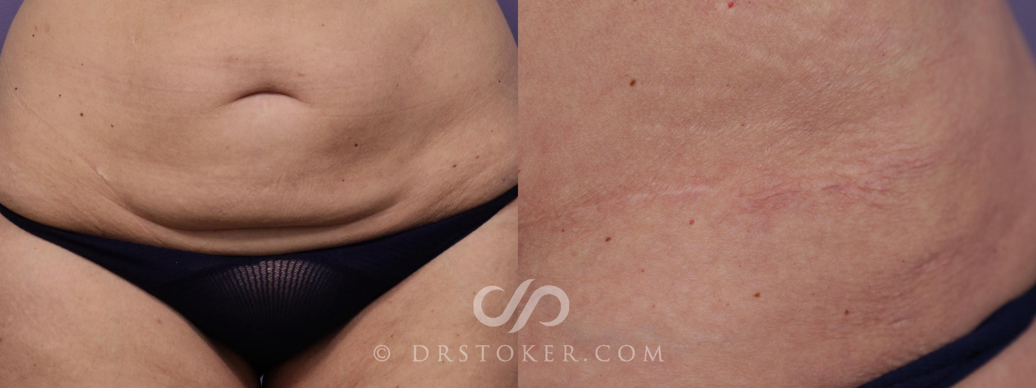 Before & After Tummy Tuck Scars  Case 1685 View #1 View in Los Angeles, CA